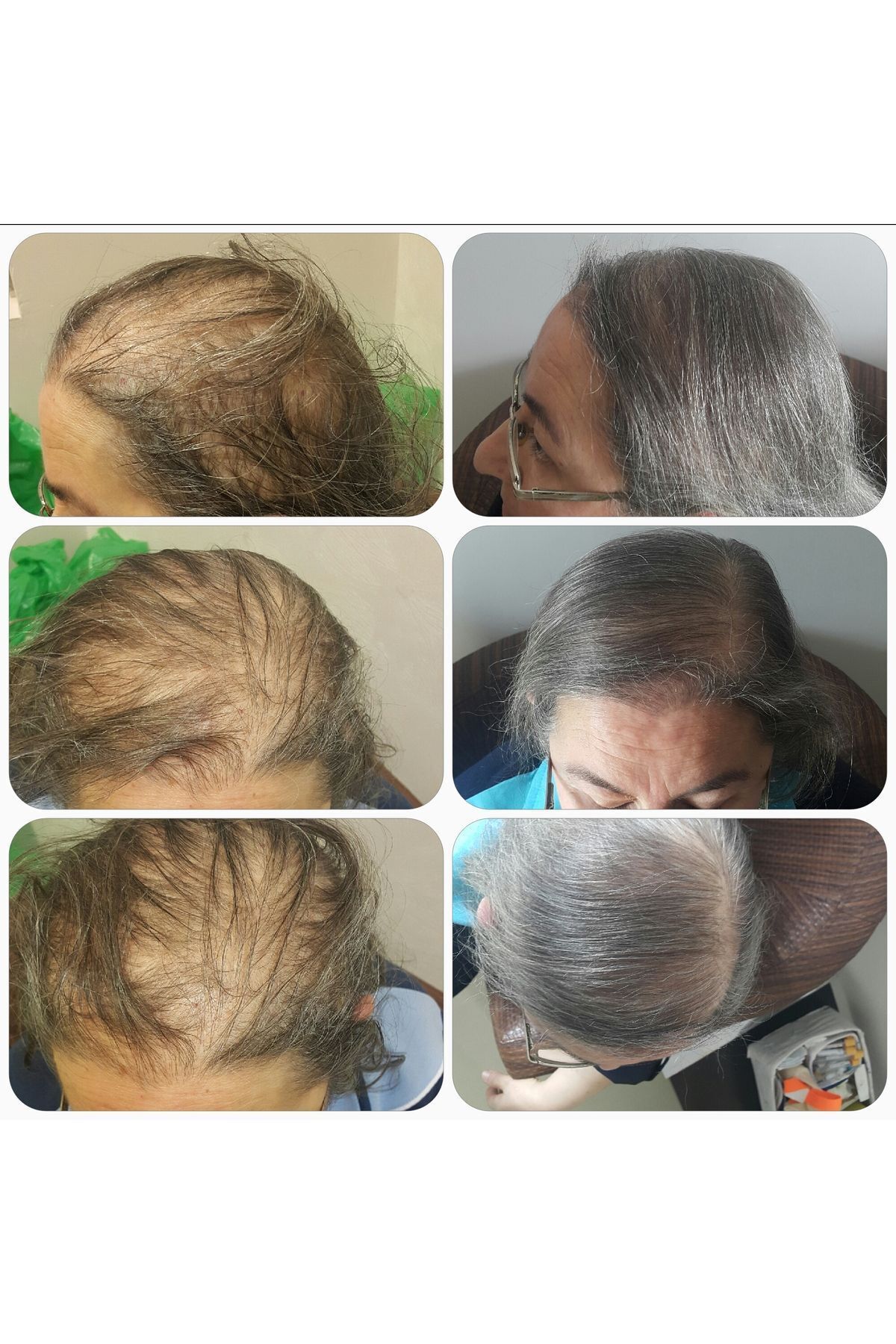 Dökülme Karşıtı Bakım Serumu – Hair Care Serum – Saç Dökülmesine Karşı Losyon Sprey Serum 100 ml — Naturalse100ml — تصویر 8 از 8