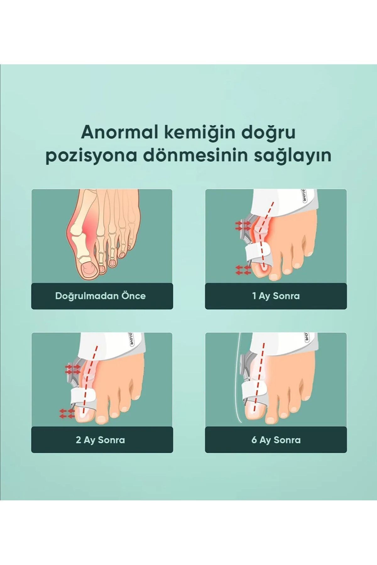 Ayarlanabilir ayak başparmak kemik düzeltici atel, rahat ve destekli kullanım sağlar 5