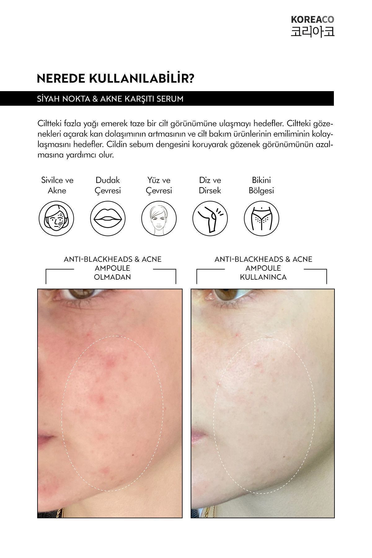 Koreaco Anti-Blackheads Acne Ampoule Siyah Nokta ve Akne Ampulü — ZnNKOREACO&SA — تصویر 4 از 6