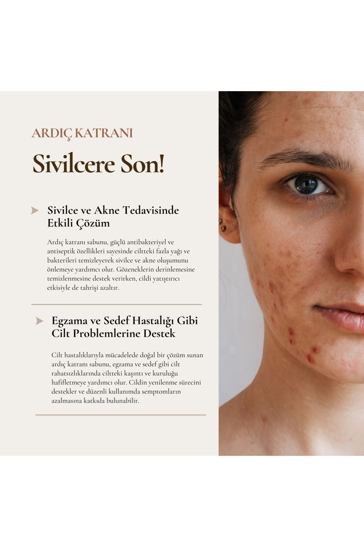 Mehmet Dede-Juniper Tar Soap (Sivilce, Acn, Egzema) 4