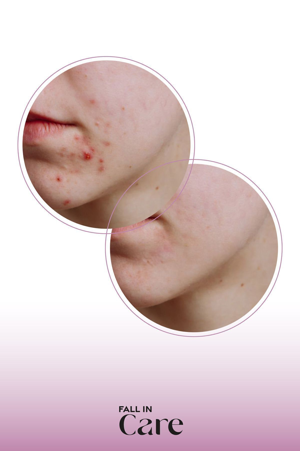 Niacinamide Serum, Siyah Nokta ve Sivilce Karşıtı, Gözenek Sıkılaştırıcı Cilt Bakım Serumu, 30ml — FICNS01 — تصویر 7 از 8