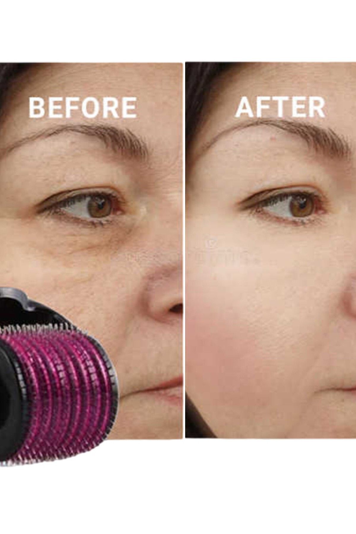 hayret sepeti ve Leke Problemlerine Karşı Derma Roller 1.00 mm Çözümü