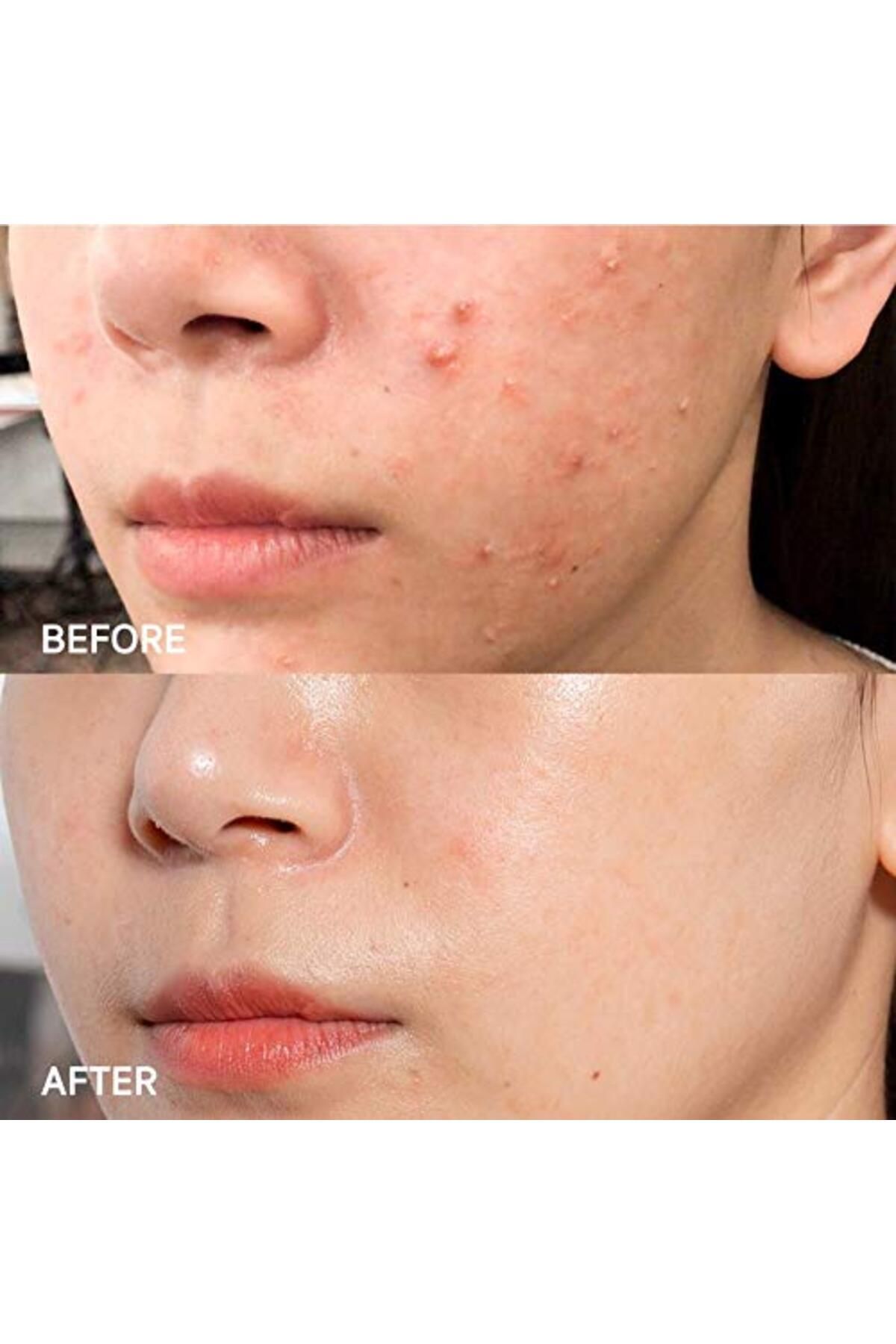 Some By Mi-AHA BHA PHA 14 Days Super Miracle Spot All Kill Cream 30ml 8