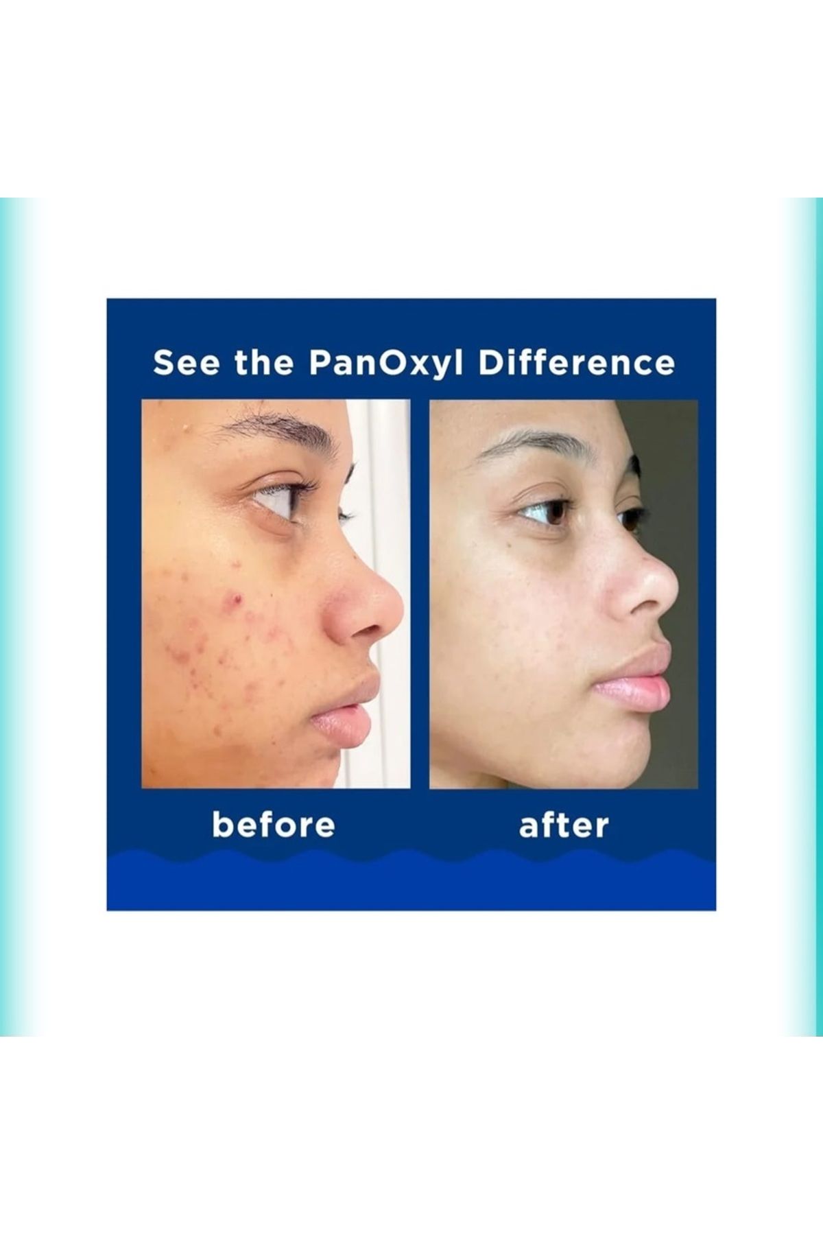 panoxyl-بانوكسيل غسول رغوي لعلاج حب الشباب بتركيز 10% من بنزويل بيروكسيد، قوة قصوى 156 جرام 2