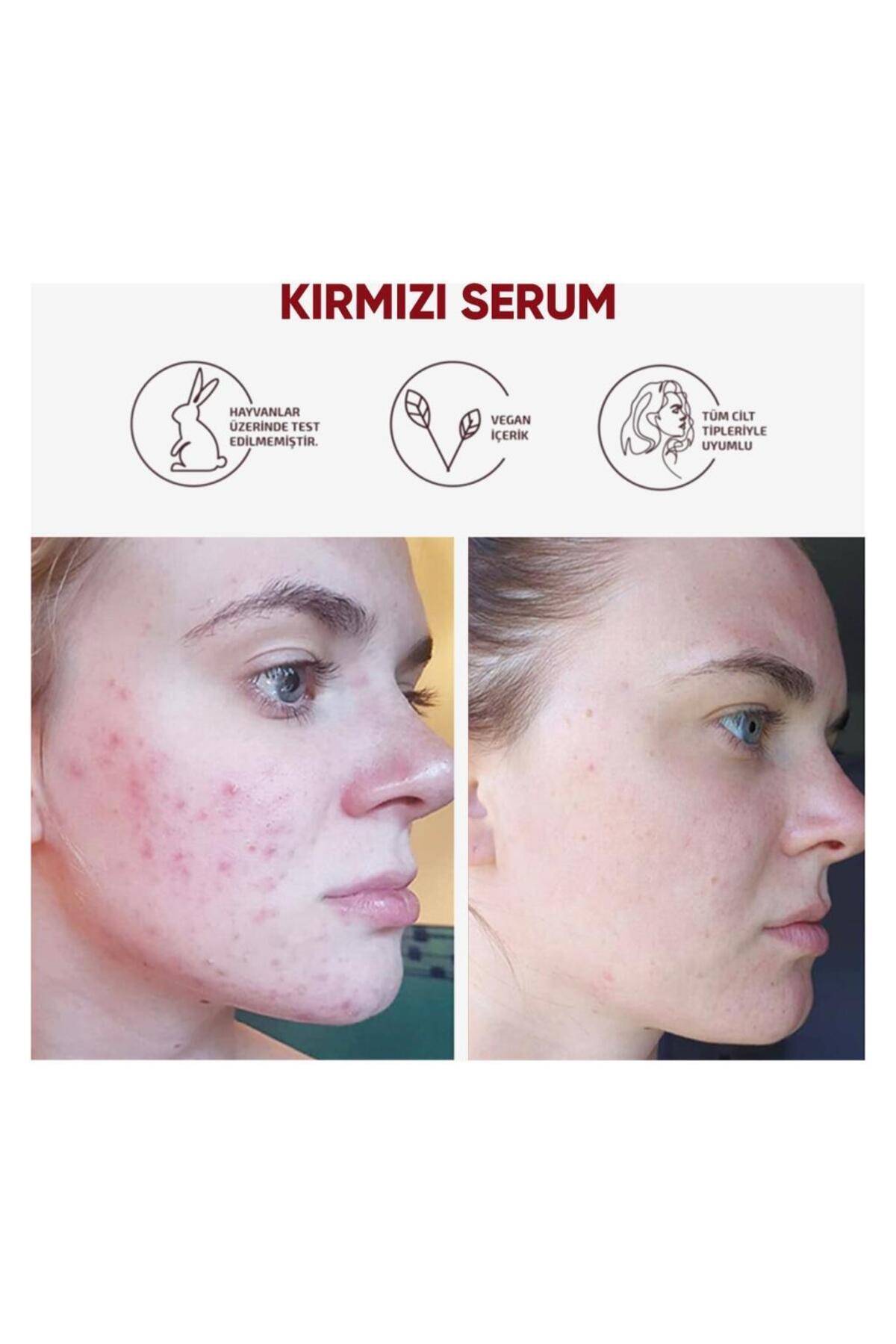 Cilt Yenileyici Cilt Tonu Eşitleyici Kırmızı Peeling Serum Aha %30 Bha %2 Ph % 3.5 Serum 30 ml — 22334455667788 — تصویر 5 از 7