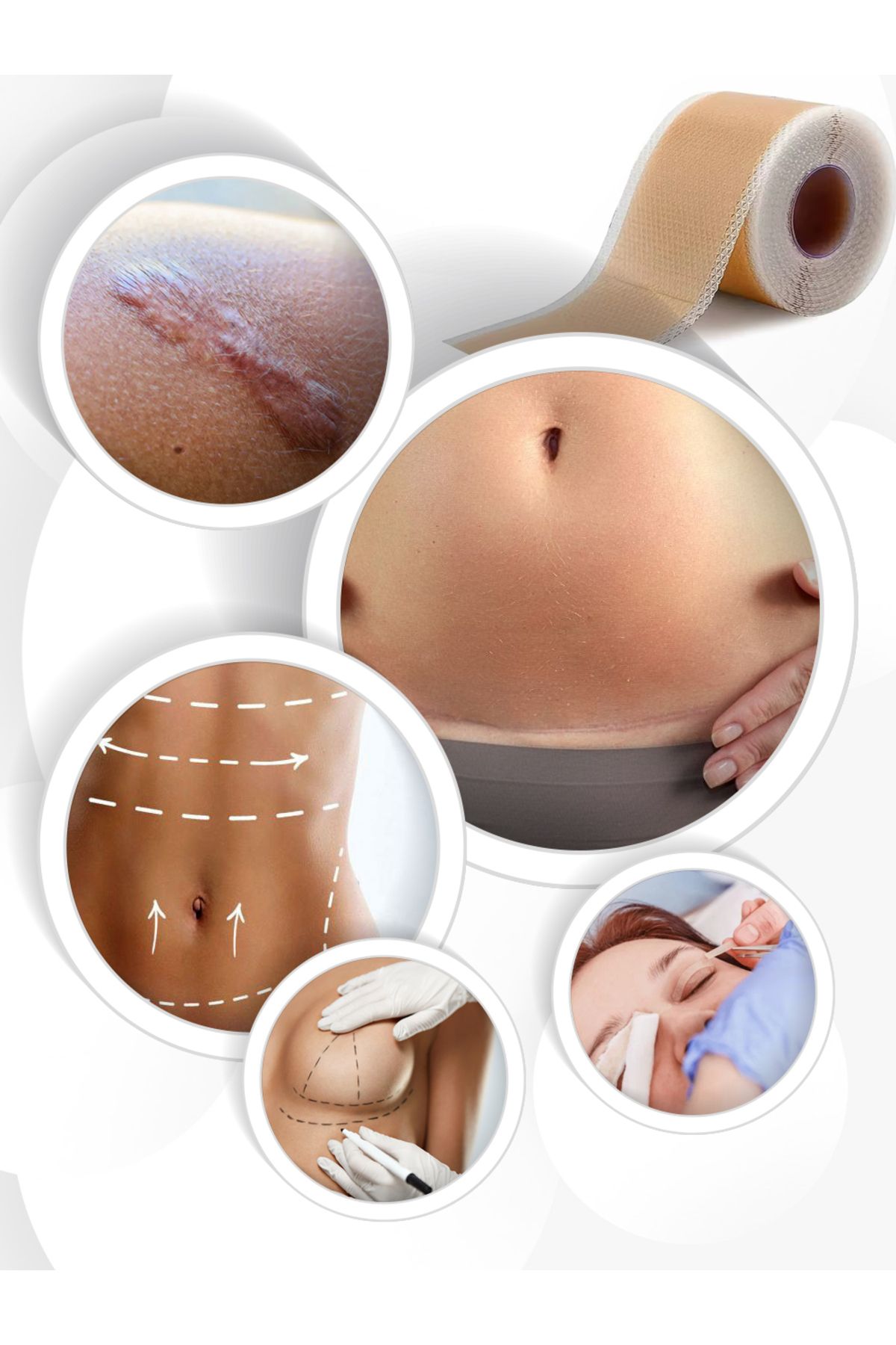 ZoneTAPE-Soft Silicone Tape - 2Cmx3Mt- Aesthetic-Scar-Keloid-Ceasarean-Section-Stitch-Abdomen/Arm/Leg Stretching-I Got It 2