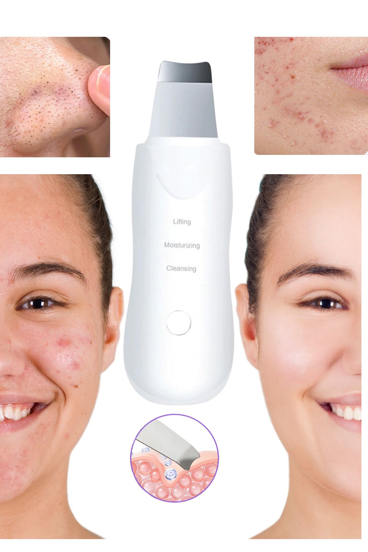 Shopura Ultrasonik Yüz Temizleyici - Giderme Cihazı -"Peeling Spatula