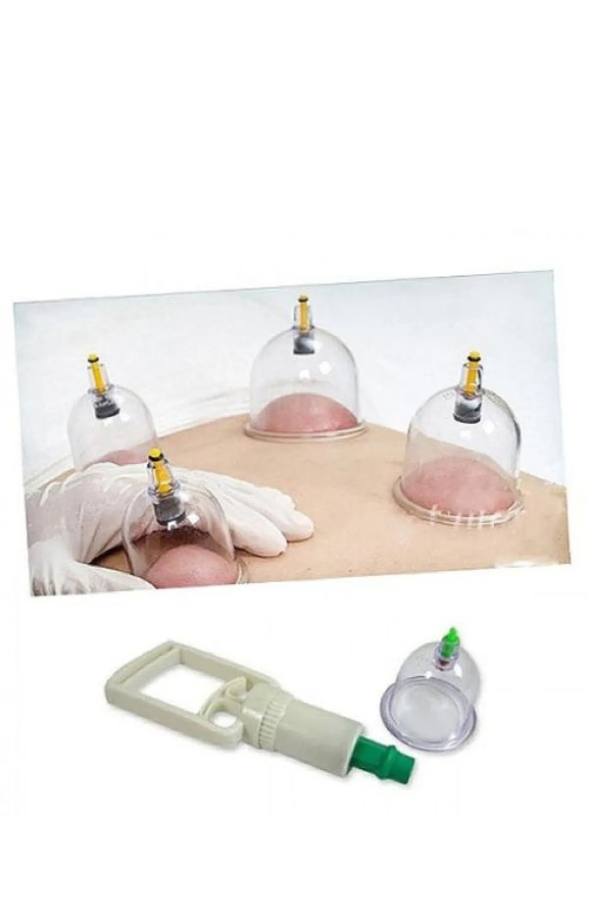 Skygo-Cupping Set - Vacuum Cupping Set (Model 1) 2
