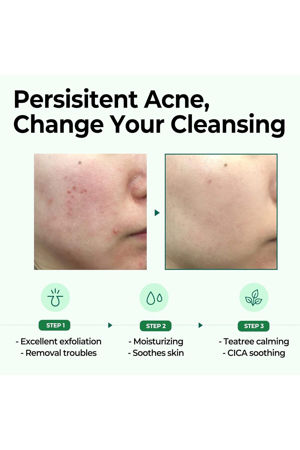 Some By Mi-Miracle Bar Soap for Skin Cleansing in 30 Days with AHA, BHA, and PHA from Some By Mi 5