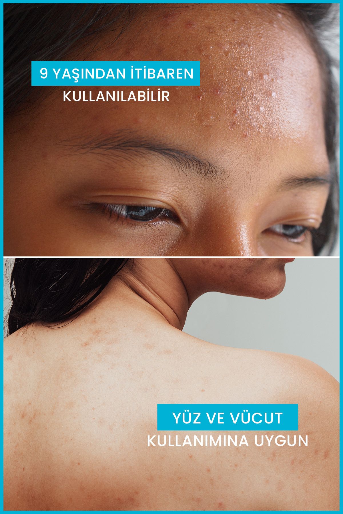 ست مراقبت پوست ژل تمیز کننده KERACNYL 400 میل X2 برای روغنی و آکنه Ducray