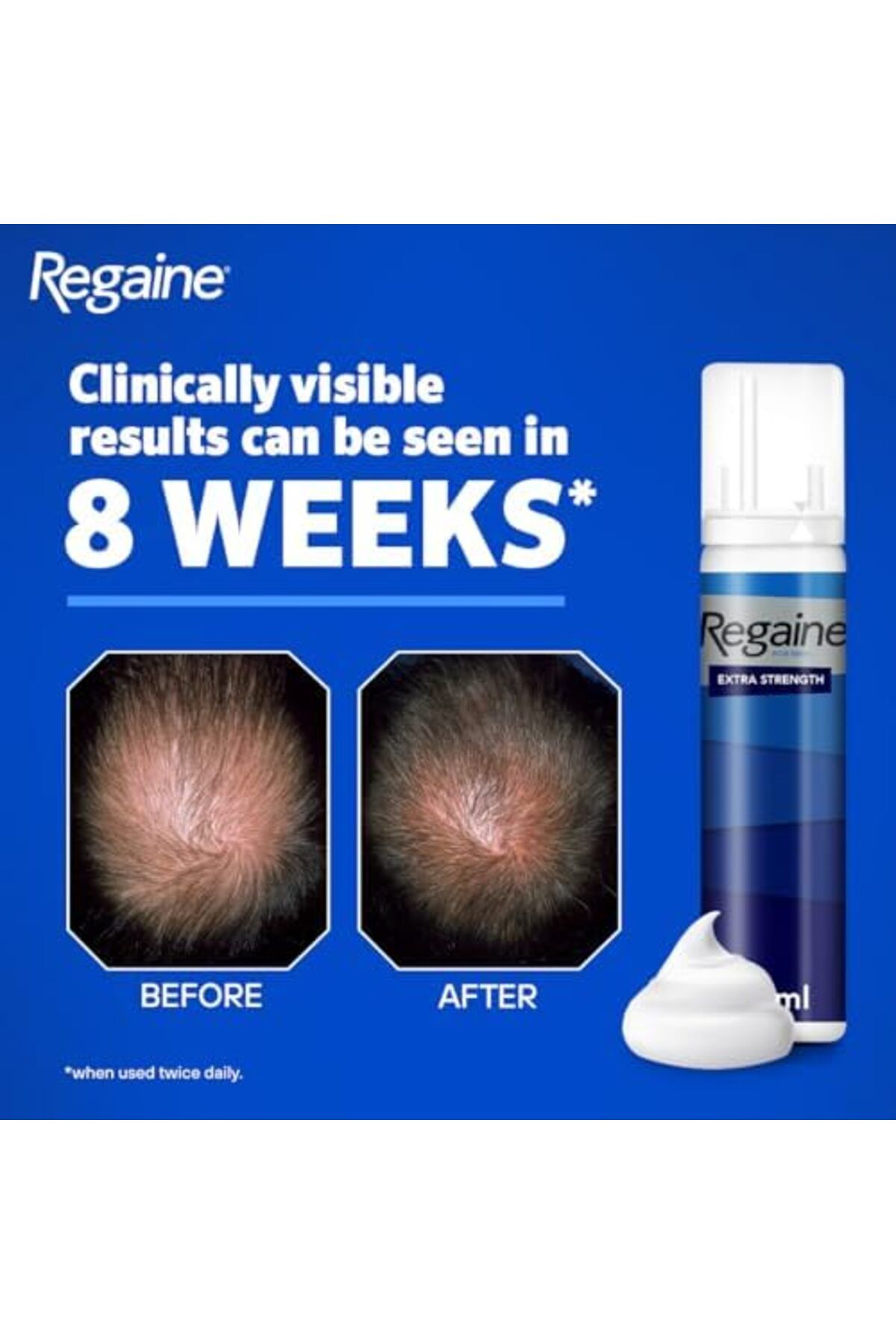 Regaine-Extra Strength Scalp Cutaneous Foam (3x 73 ml), Treatment for Regrowth in Men with 5% Minoxi 4