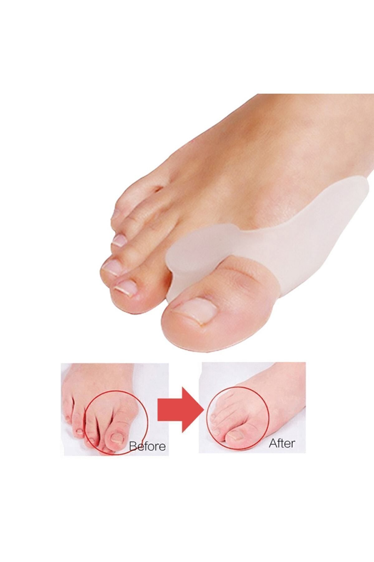 AboutThePerfect Konforlu Silikon Çift Hallux Valgus ve Çekiç Parmak Düzeltici Set