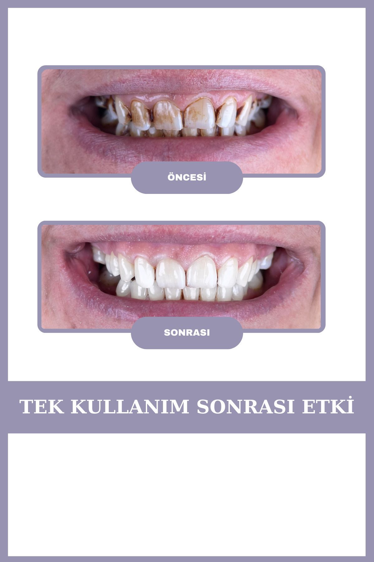 AVANT DENTAL SUPPLY 3 Tüp Diş Beyazlatıcı Üzüm Aromalı Sigara Çay Kahve Lekesi Için Profesyonel Bakım(3 AYLIK)