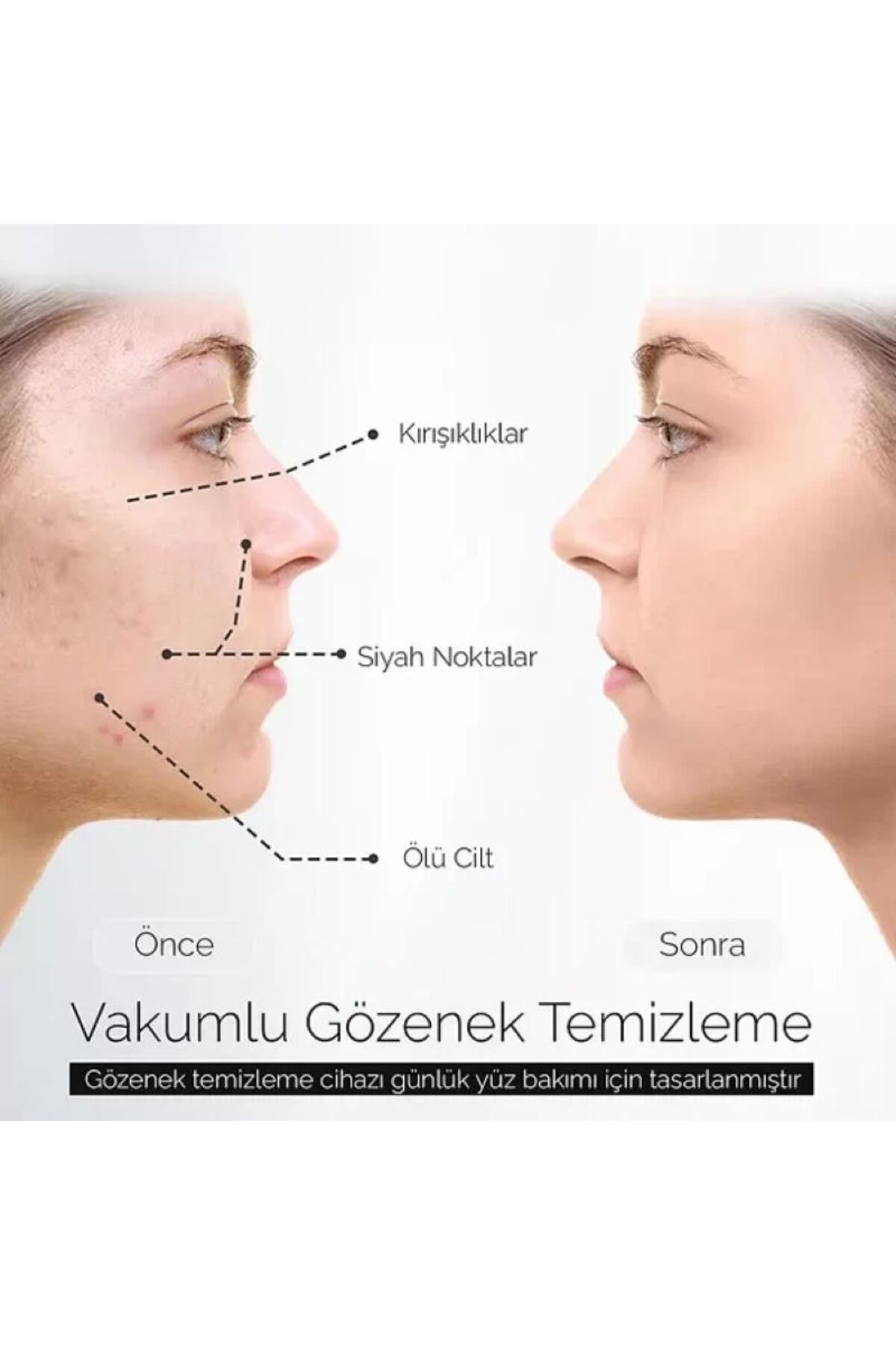 5 Kademeli Profesyonel Vakumlu Siyah Nokta ve Akne Temizleme Cihazı — P3030S4922 — تصویر 4 از 6