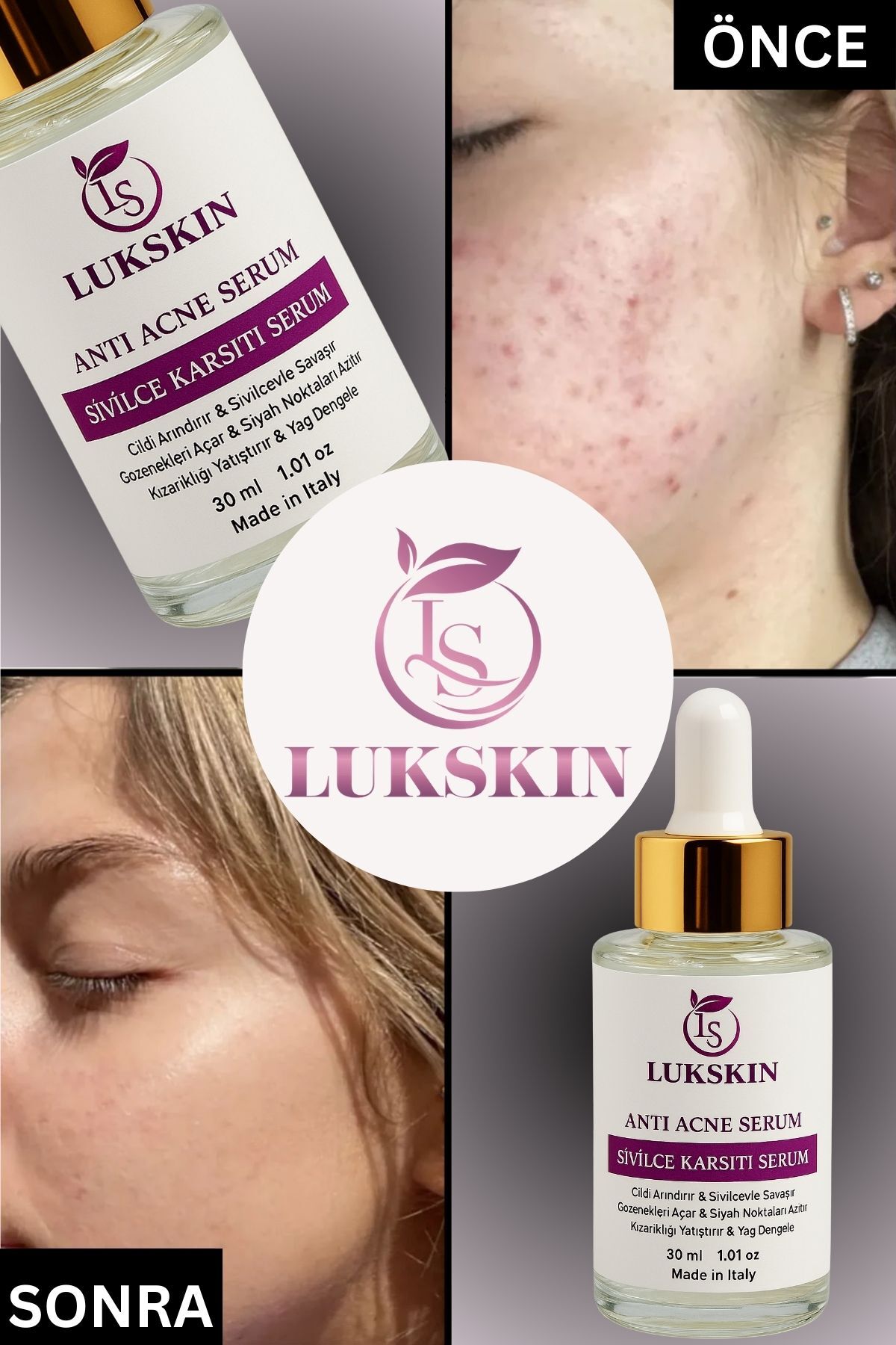 Akne ve Karşıtı Serum - Akne Kurutucu - Siyah Nokta Leke İz Akne Komedon Karşıtı — 6 — تصویر 5 از 6