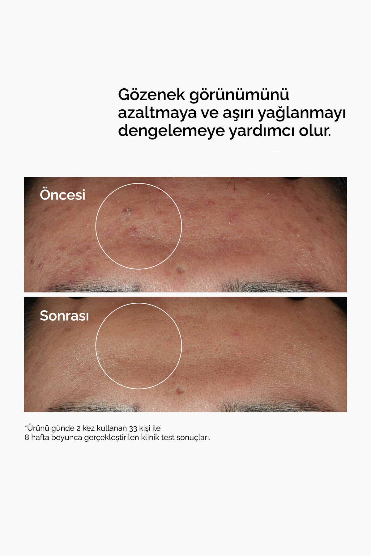 Niacinamide 10% + Zinc 1% - Leke ve Gözenek Görünümü Karşıtı Serum 60ml — 769915195958 — تصویر 4 از 8