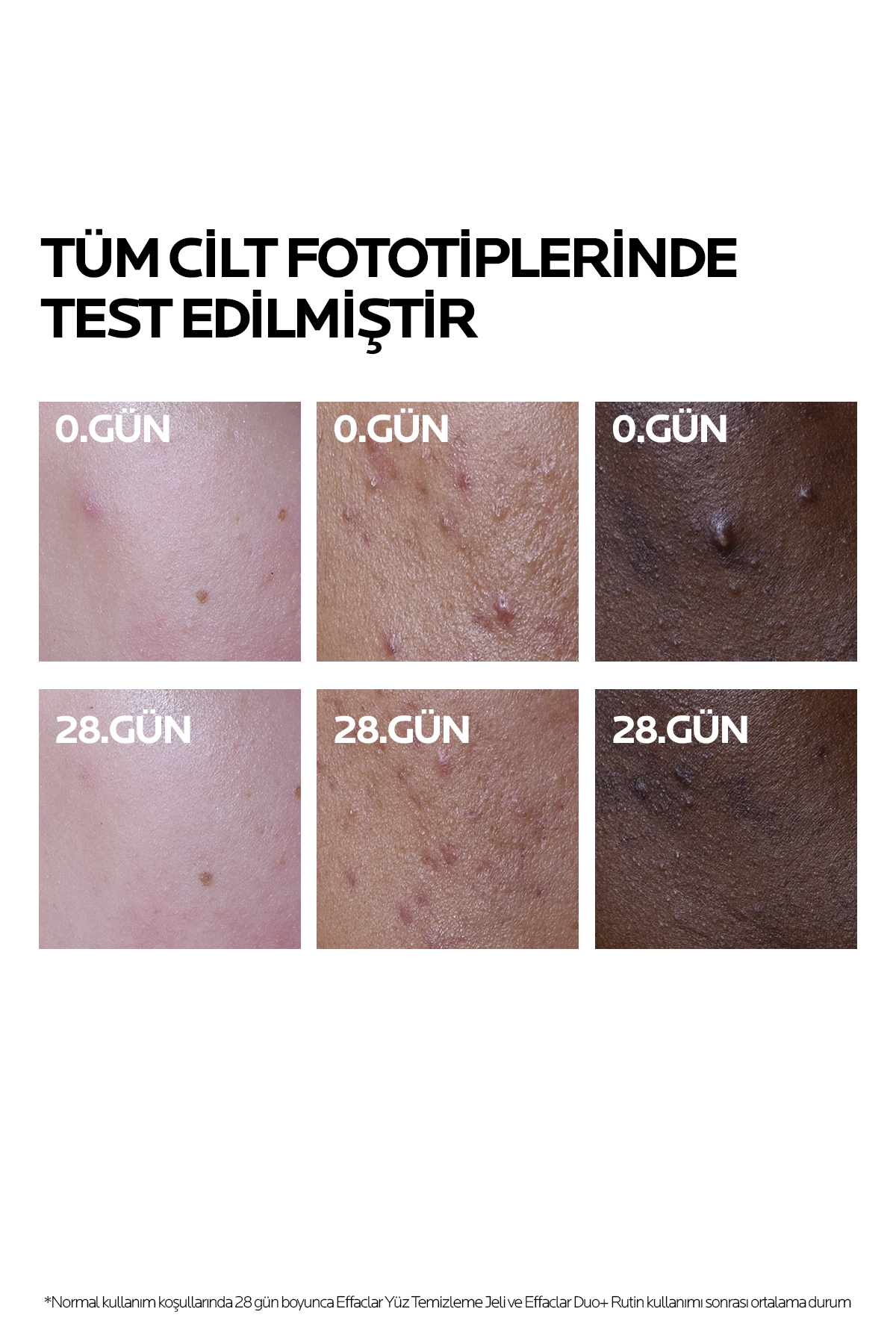 Yağlı ve Akneye Eğilimli Ciltler İçin Cilt Bakım Seti: Effaclar Temizleme Jeli 400ml&Duo+M Krem 40ml — LRP20250025 — تصویر 8 از 8