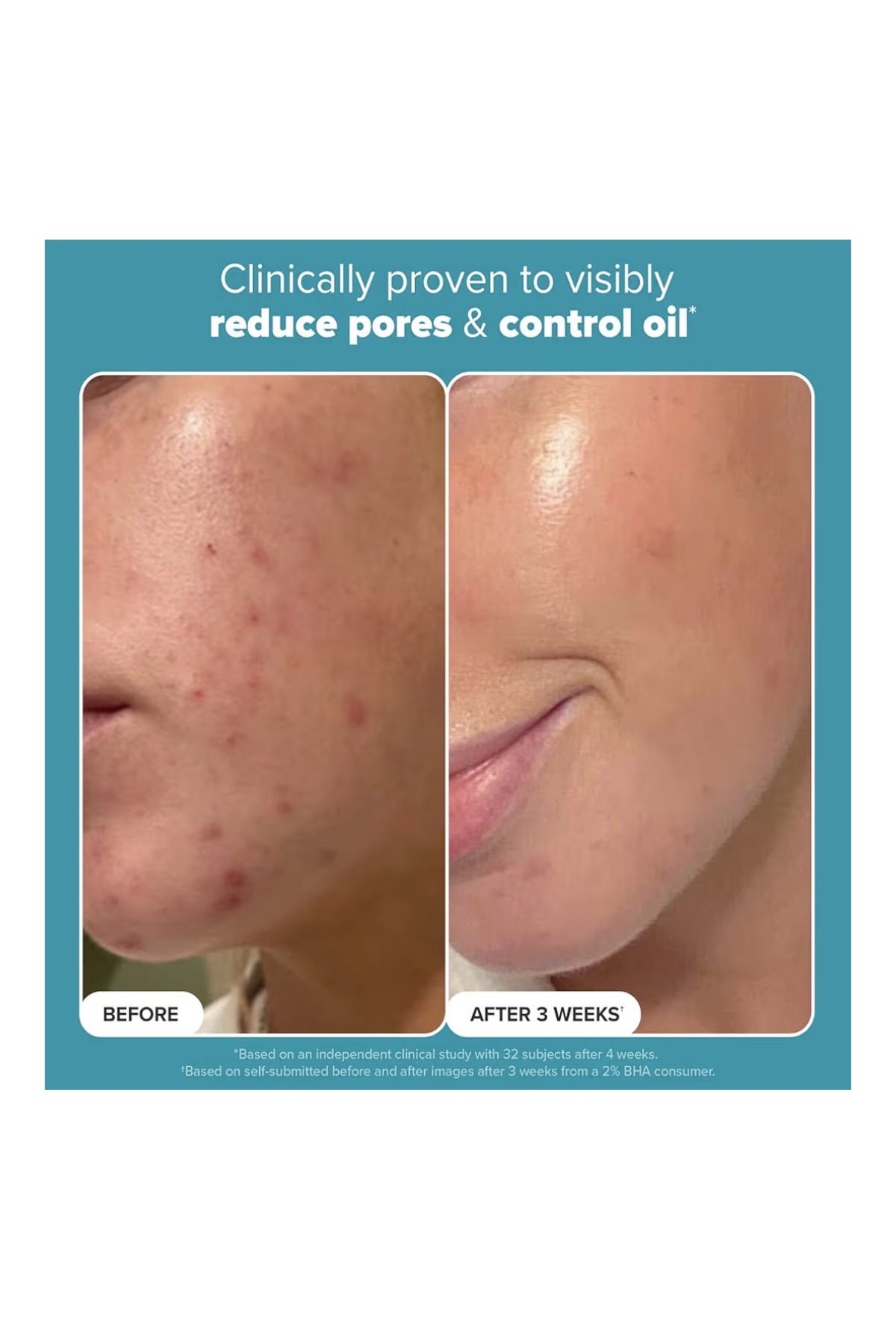 Skin Perfecting 2% BHA Liquid Salicylic Acid Exfoliant, Gentle Facial Exfoliator for Blackheads 1fl Supplements, — gh6tgf — تصویر 3 از 7