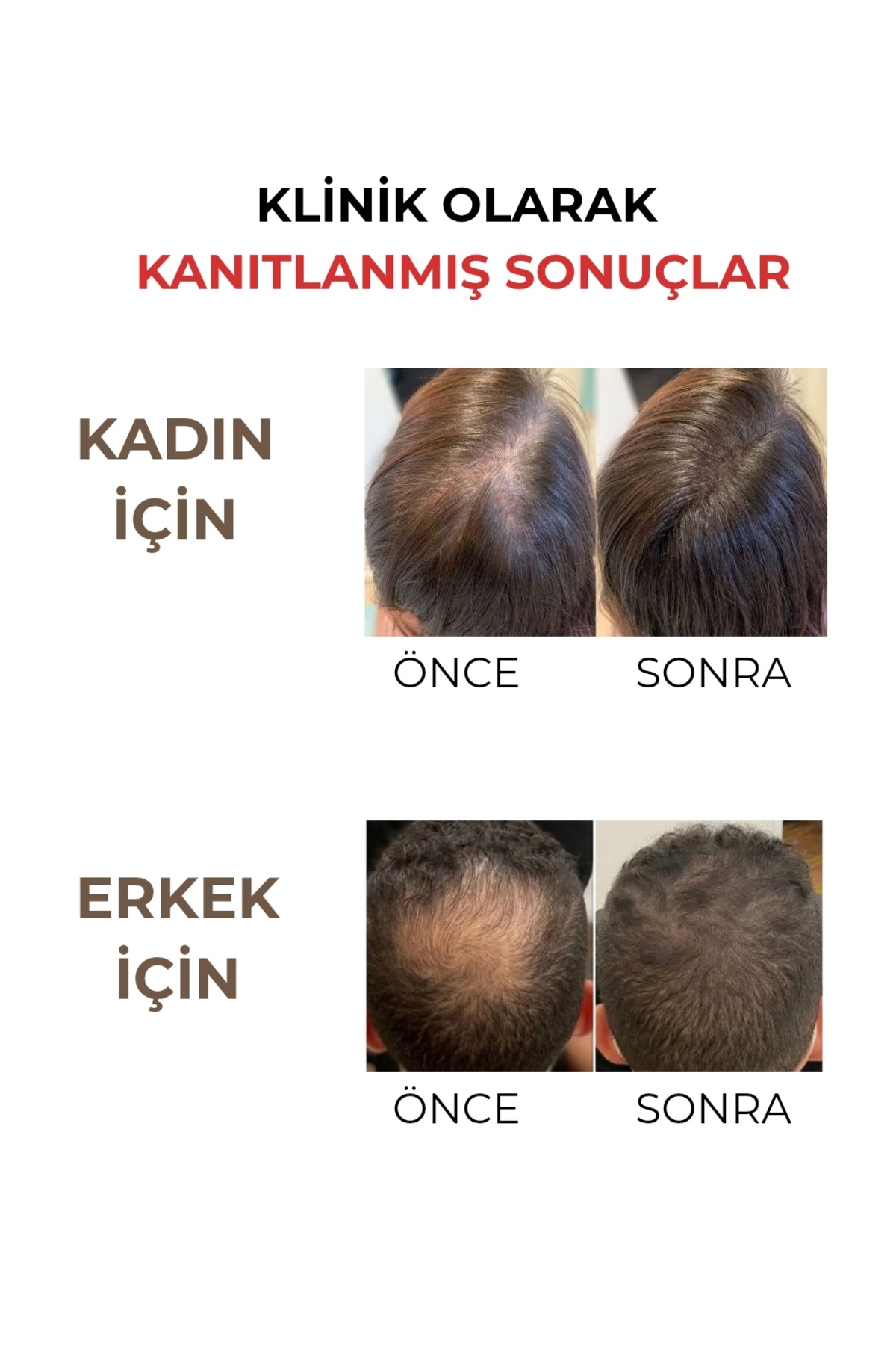 Saç Spreyi – Dökülmeye Karşı Yoğun Bakım (Redensyl + Procapil + Anagain) — 1 — تصویر 3 از 5