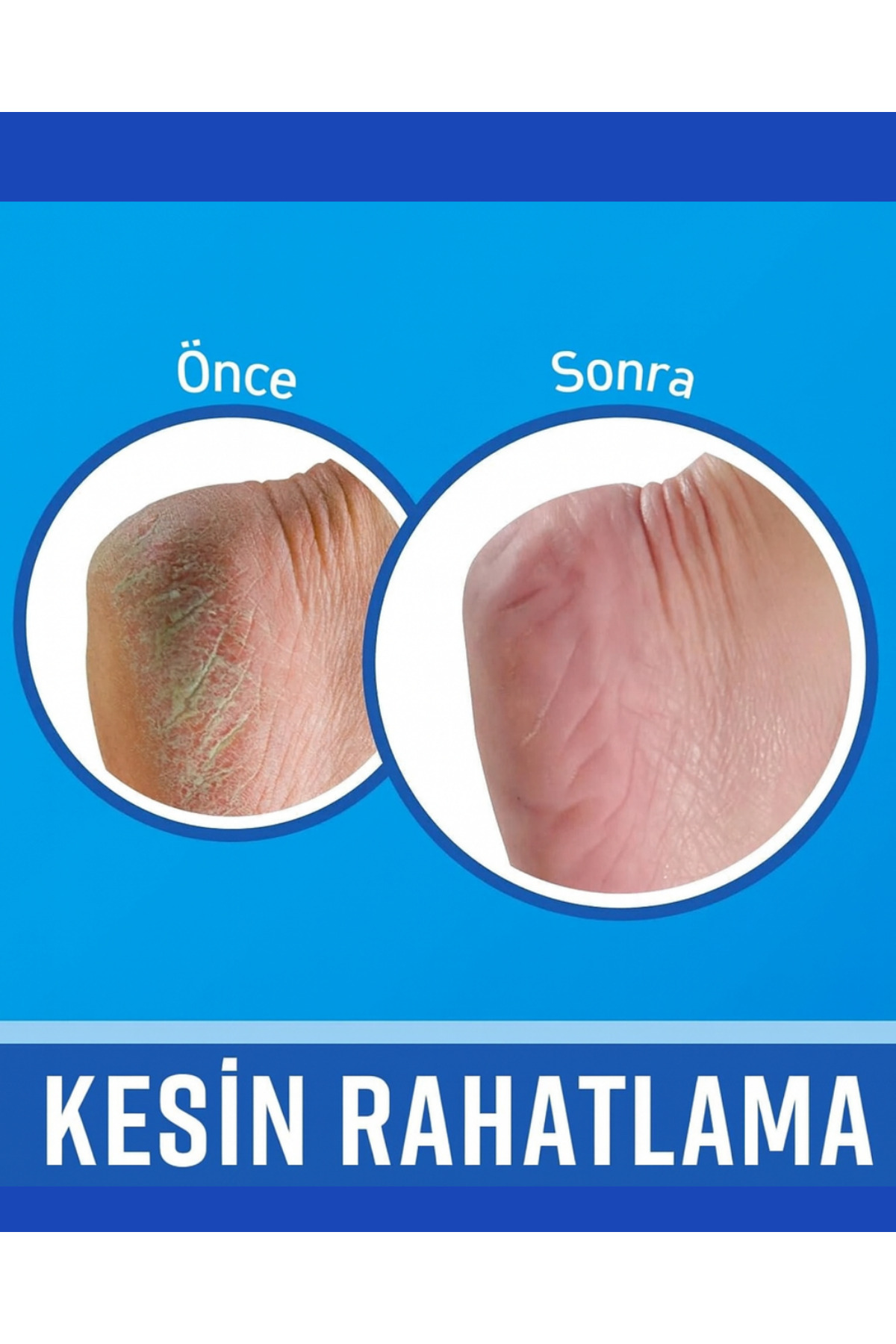 U.K Pedicare Çatlak Topuk Onarıcı Roll-On – 48 Saat Etkili Yoğun Bakım 50 ml — 5017371154725 — تصویر 9 از 9