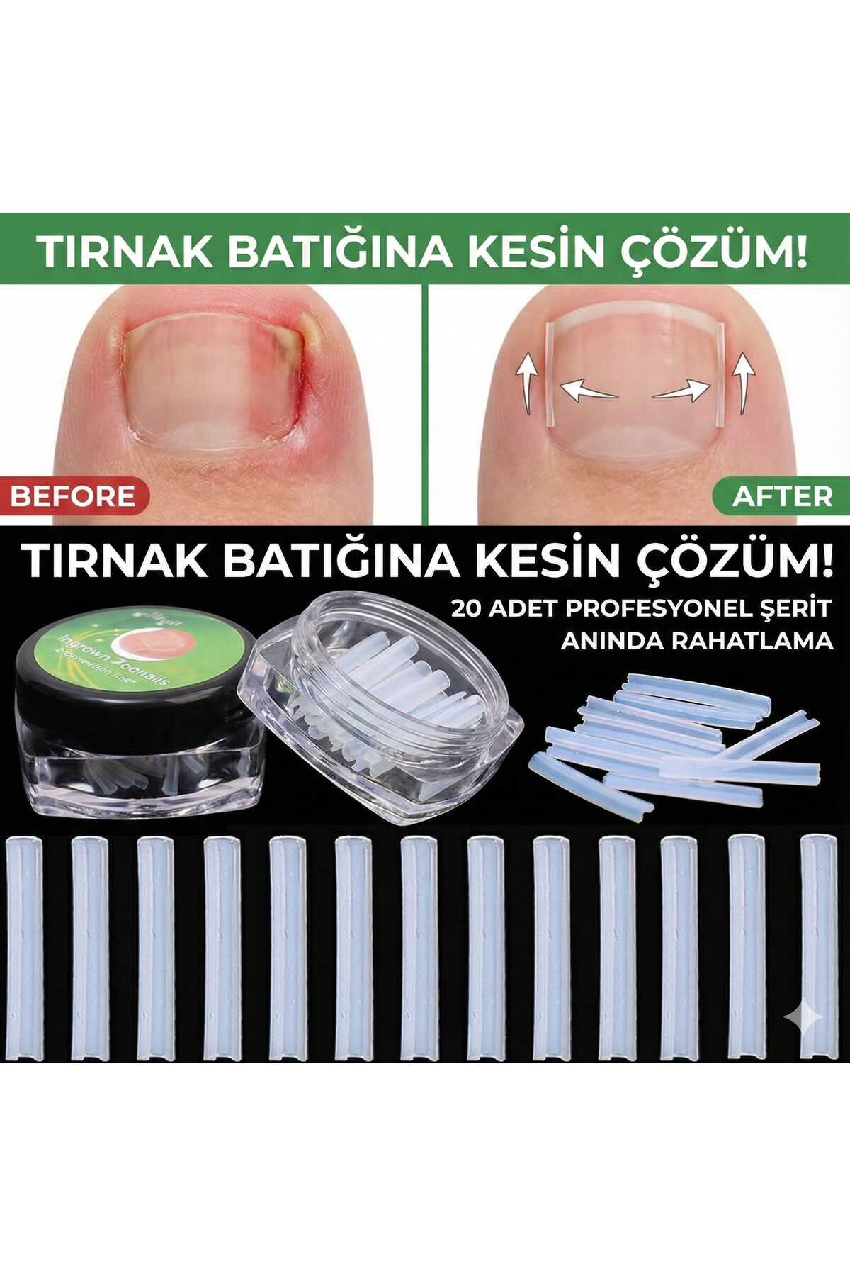 LOVYCO Batık Tırnak Düzeltici Plastik Şeritler 20 Adet - Fiyatı, Yorumları