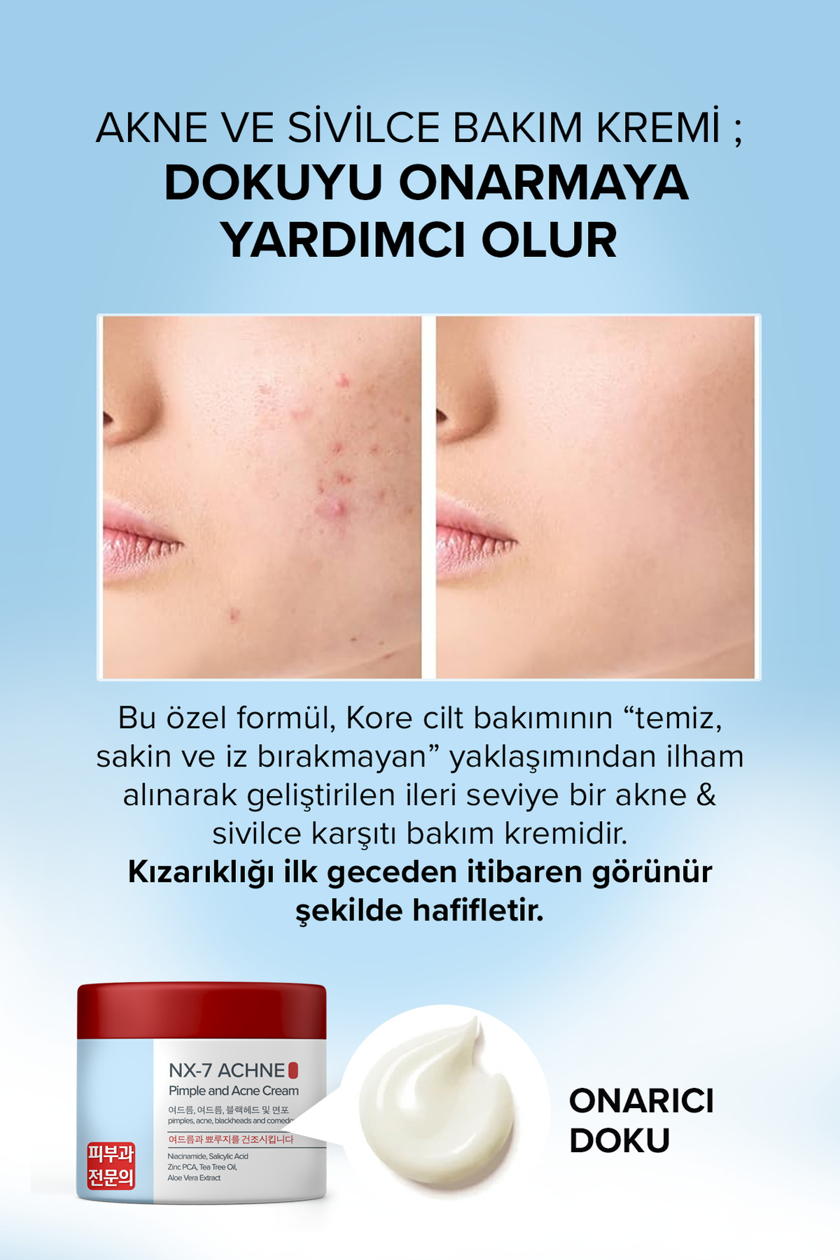 Nx7 Akne Kremi — aknekremi — تصویر 2 از 5