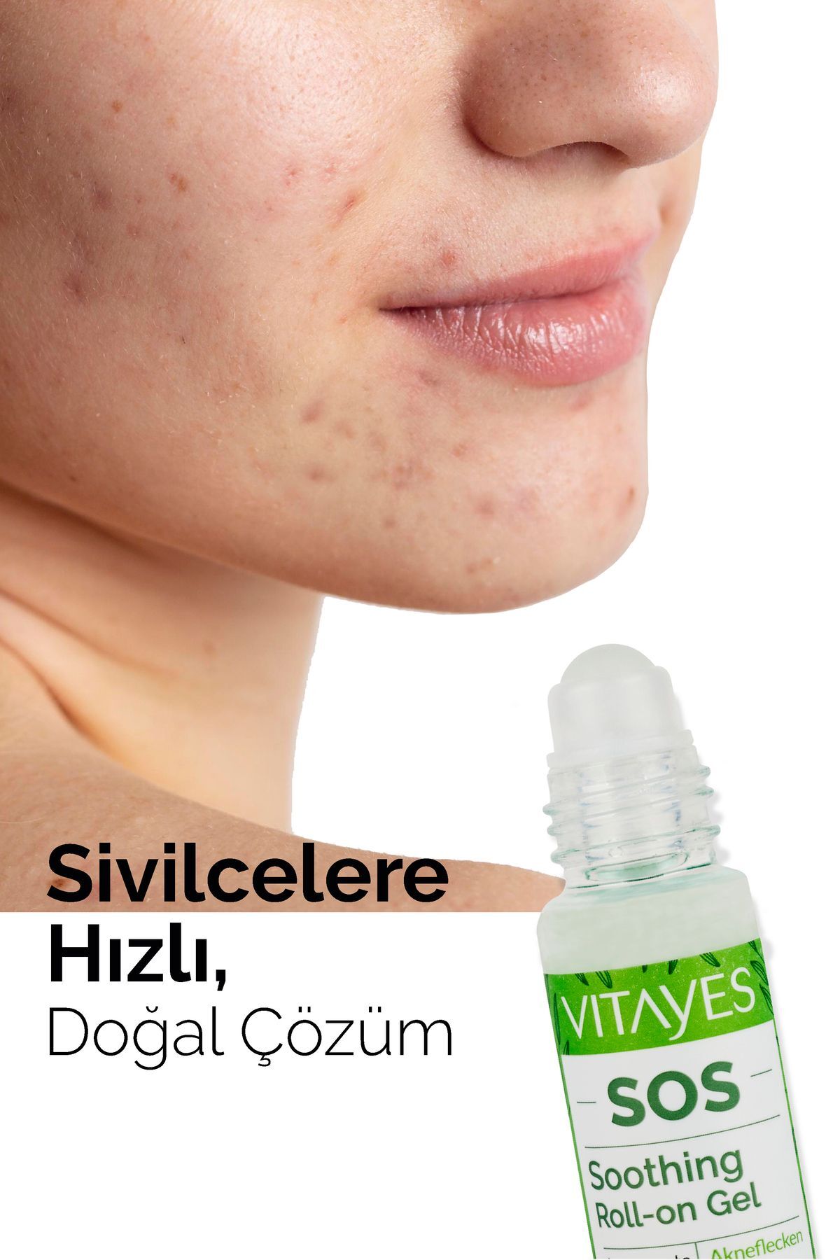 Sos Serum Siyah Nokta Akne Sinek Isırması Cilt Problemi Onarıcı Çay Ağacı Yağı Cilt Serumu 30 ml — 531 — تصویر 3 از 9