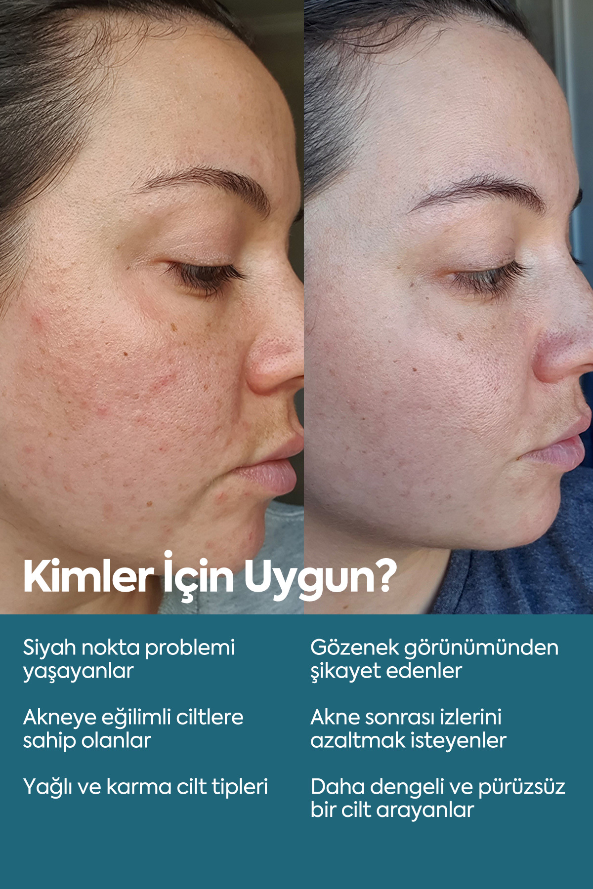 Siyah Nokta Ve Karşıtı, Önleyici Serum, Niasinamid Ve Çinko — akne serum — تصویر 6 از 8