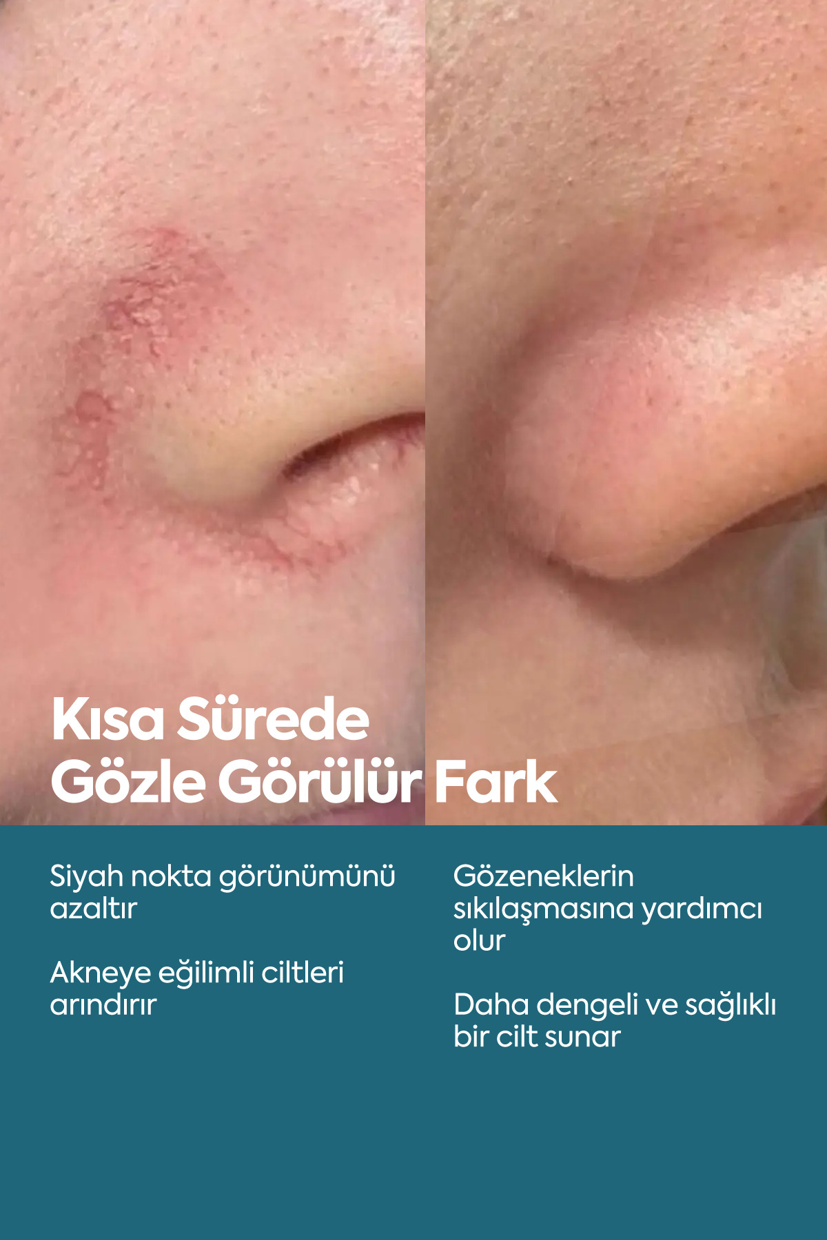 Siyah Nokta Ve Karşıtı, Önleyici Serum, Niasinamid Ve Çinko — akne serum — تصویر 4 از 8
