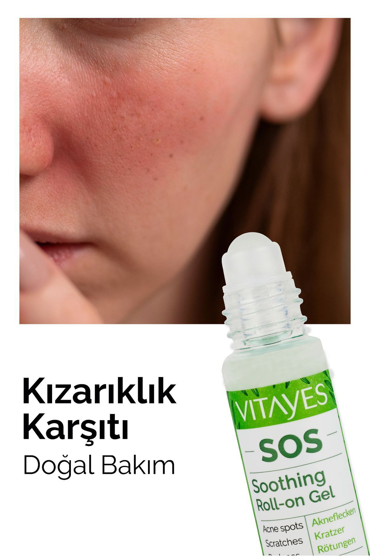 Sos Serum Siyah Nokta Akne Sinek Isırması Cilt Problemi Onarıcı Çay Ağacı Yağı Cilt Serumu 30 ml — 531 — تصویر 6 از 9