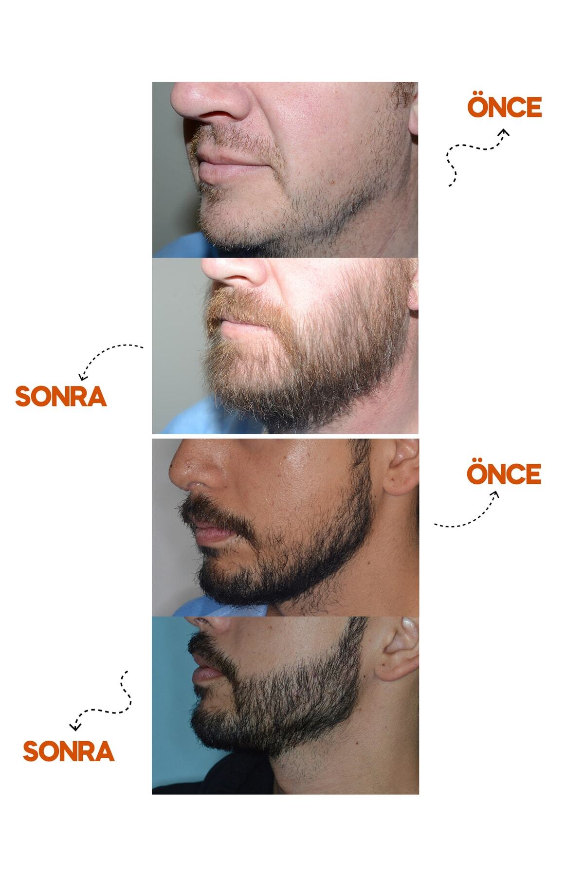 سرم ریش ۳۰ میلی‌لیتری + ست درمارولر — 8VH621TNCV9A — تصویر 7 از 7