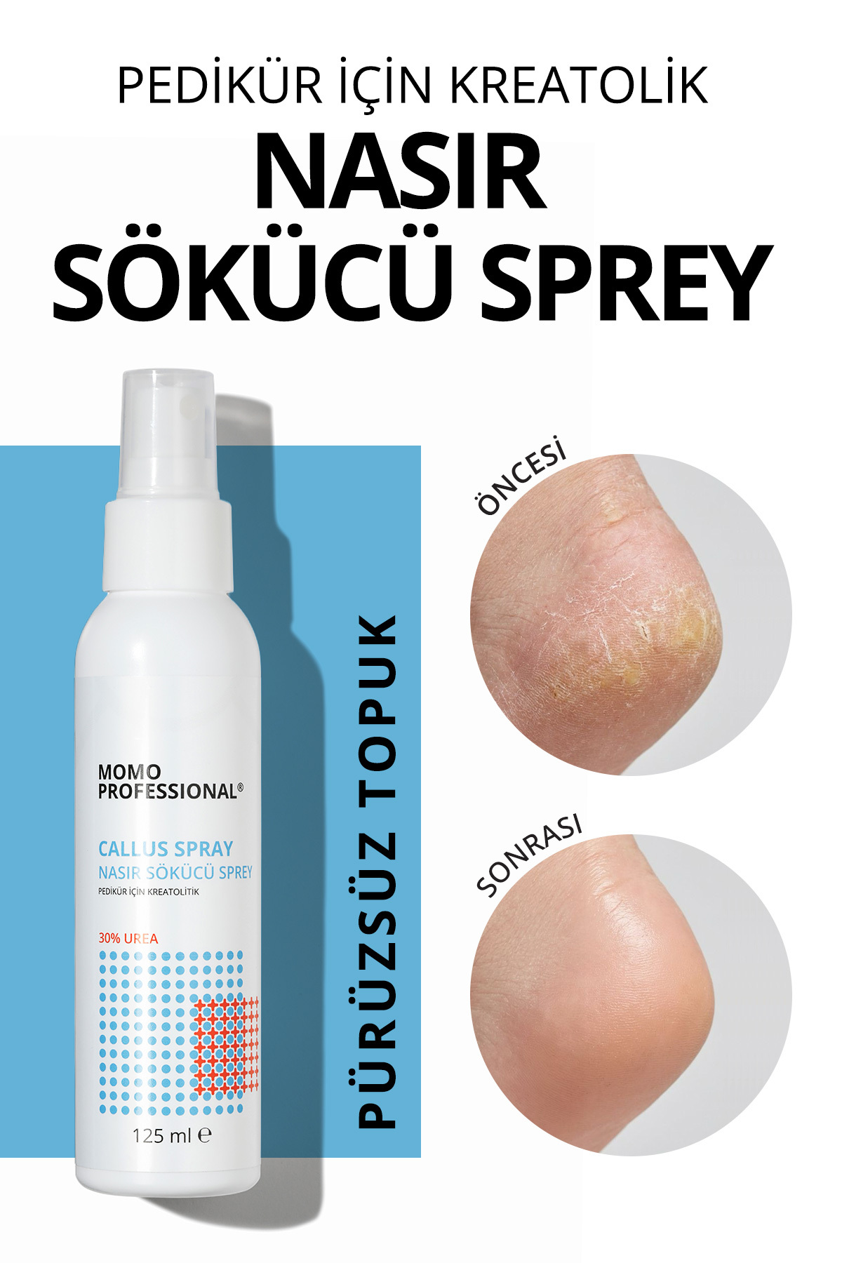 MOMO professional Callus Sprey, Nasır Sökücü Sprey, Pedikür Için Keratolitik Sprey, 125 ml — 1900107G07S10KR00