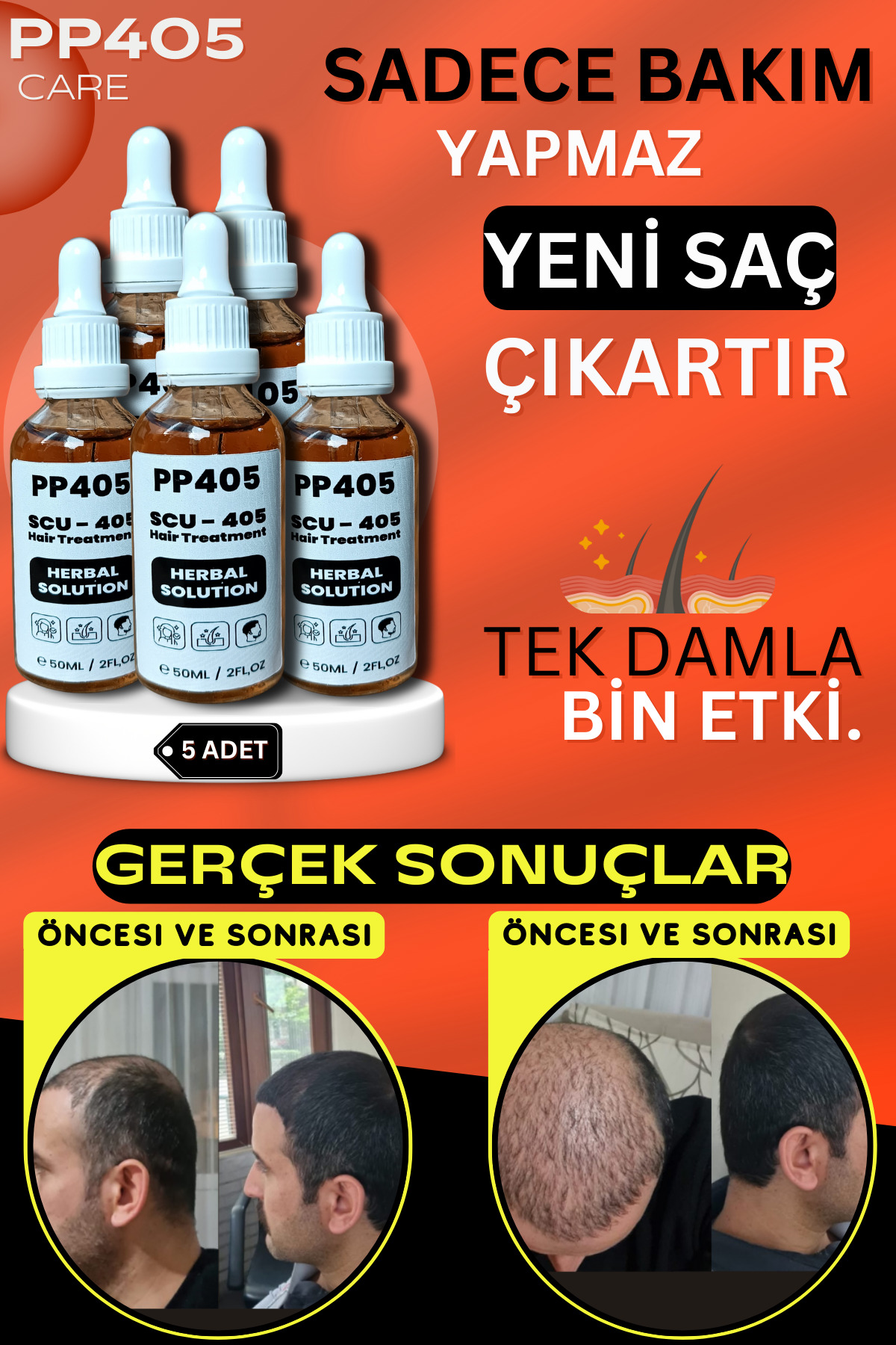 Saç Çıkartıcı Saç Gürleştirici Dökülme Karşıtı Anti-Hair Loss Oluşumu Saç Serumu 5 Adet — 4543454