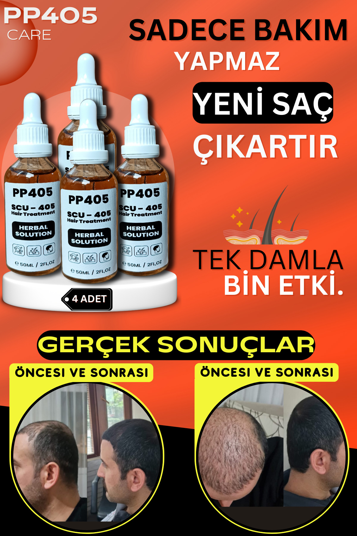 Saç Çıkartıcı ve Gürleştirici Serum Kellik Karşıtı Kel Bölgeler İçin Hızlı Saç Uzatma - 4 Adet — 45256352