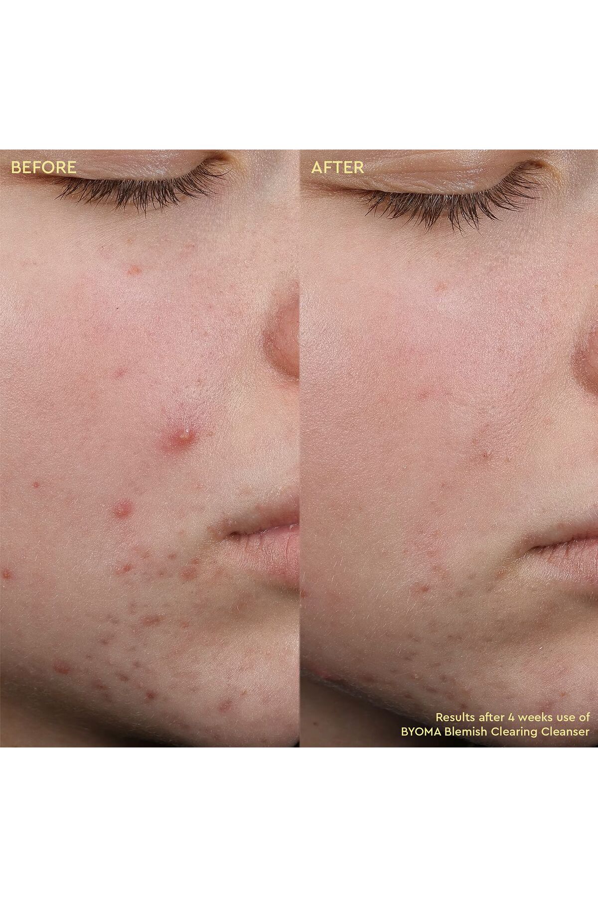 Blemish Clearing Cleanser - Cilt kusurları karşıtı temizleyici 175 ml CSM — 8932748923CSM — تصویر 3 از 3