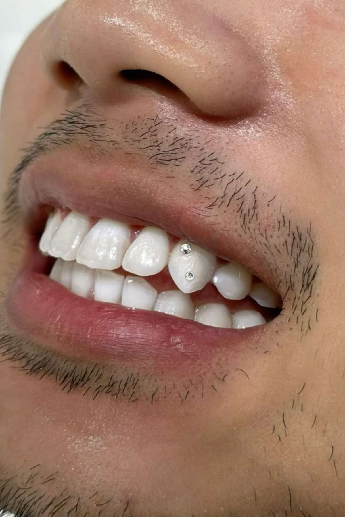 DENTYCRYSTAL Diş Pırlantası Classic Çift (Avusturya Kristallerinden Oluşturulmuş Classic Set ) görsel 5