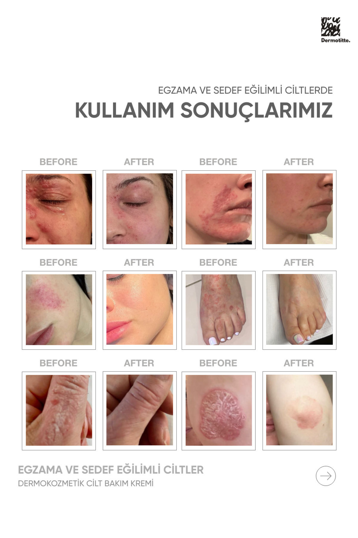 Dermotitte Bariyer Onarım Seti | Saç Bakım Şampuanı 250 ml + Onarıcı Krem — Avantajlıpaket — تصویر 8 از 8