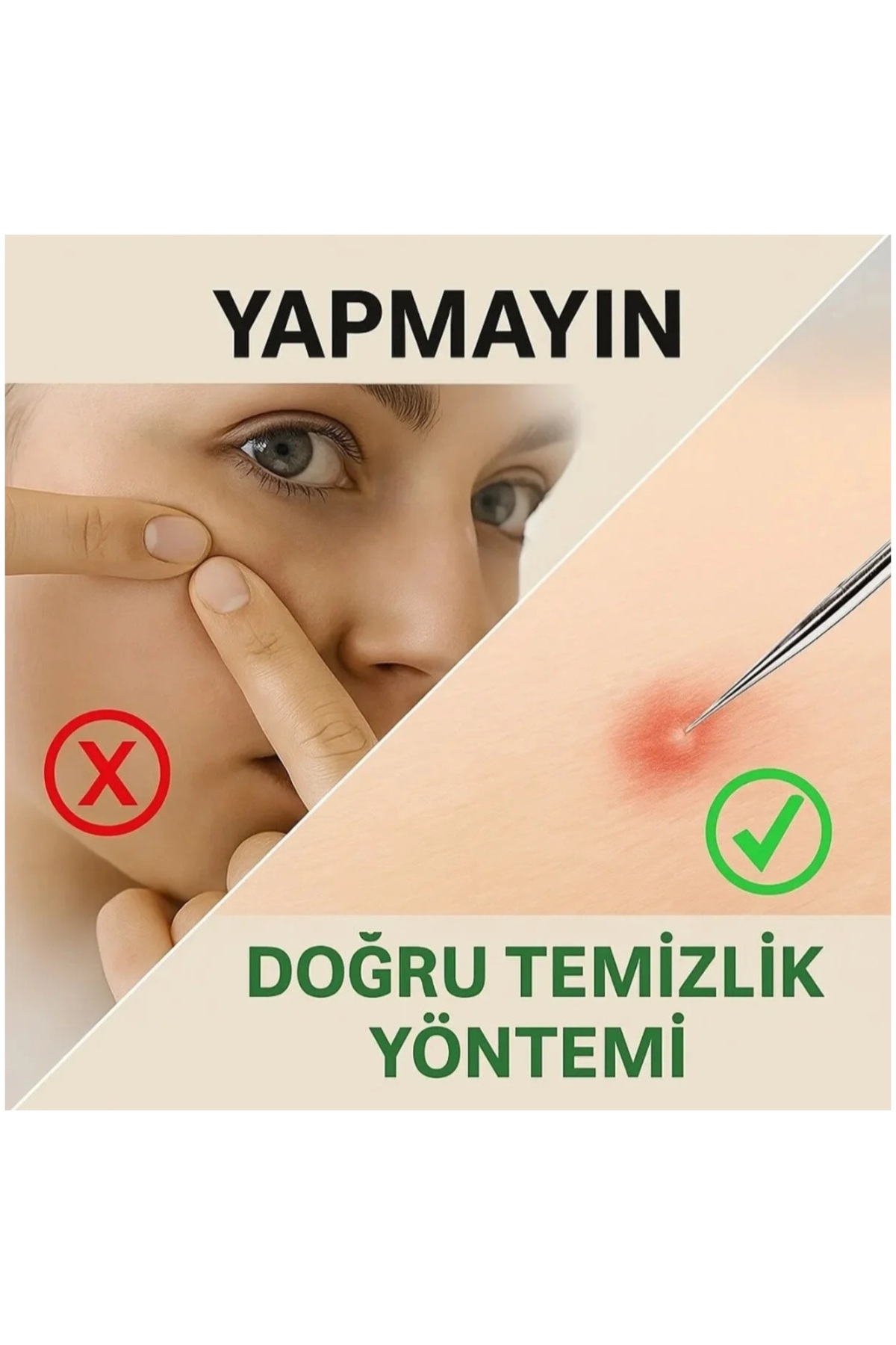 4 Parça Celik Paslanmaz Çelik Sivilce Akne Siyah Nokta Temizleme Aparatı — TYC7RQ6ZAN168798767765162 — تصویر 5 از 8