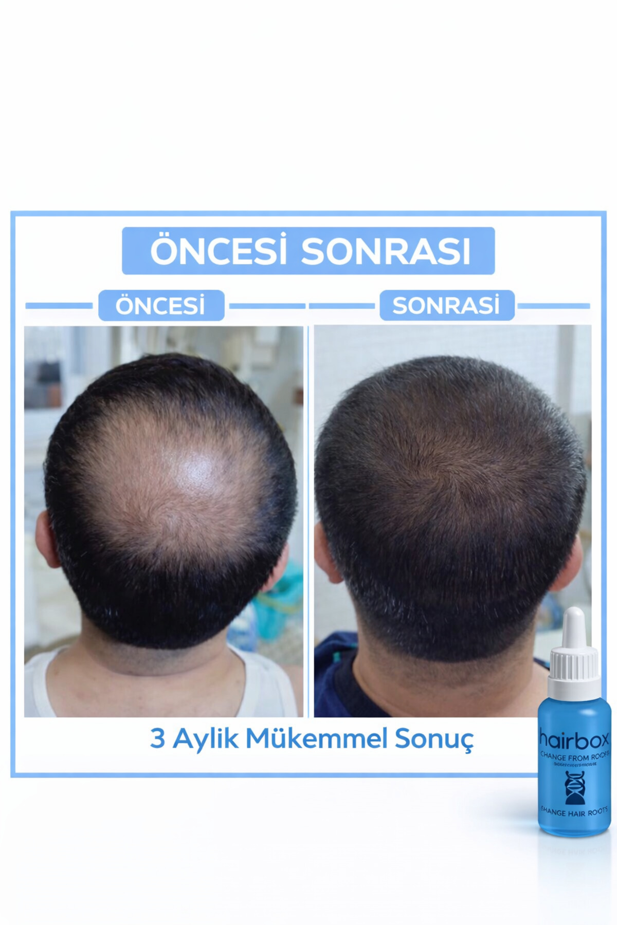 Erkek Saç Çıkarıcı Serum, Saç Çıkaran Serum , Saç Gürleştirici (5 ADET SERUM ŞAMPUAN TARAK VE YAĞ) — TYCDXEYEUN171123004389715 — تصویر 8 از 8