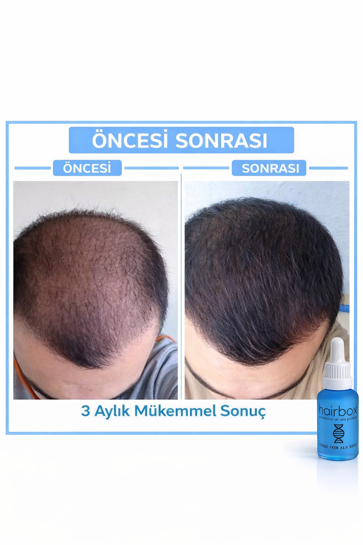 Erkek Saç Çıkarıcı Serum, Saç Çıkaran Serum , Saç Gürleştirici (5 ADET SERUM ŞAMPUAN TARAK VE YAĞ) — TYCDXEYEUN171123004389715 — تصویر 7 از 8