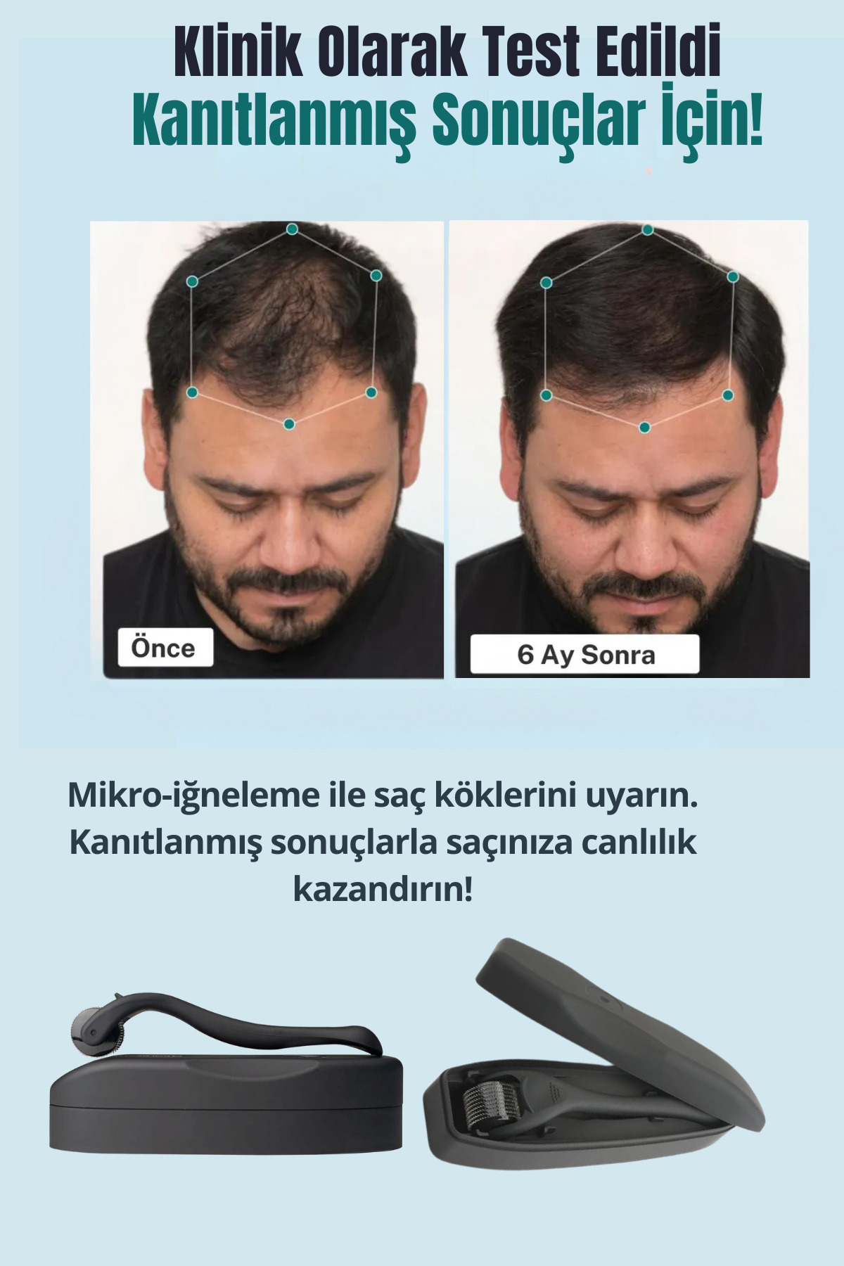 Saç ve Gürleştirme Bakım Seti – Dermaroller, Saç Sakal Serumu ve Biberiye Suyu — set9 — تصویر 5 از 8