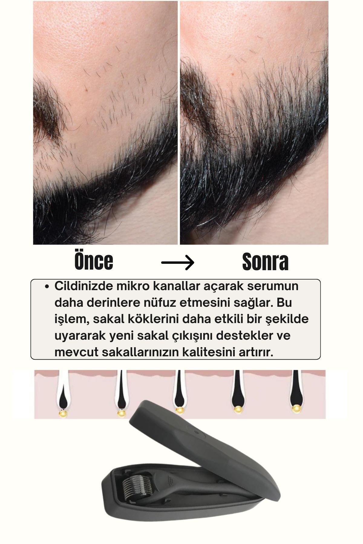 Seyrek Saç Sakal Serumu Ve 540 İğneli Dermaroller 1 mm Dezenfektan Seti – Saç Sakal Bakım Aleti — set10 — تصویر 9 از 9
