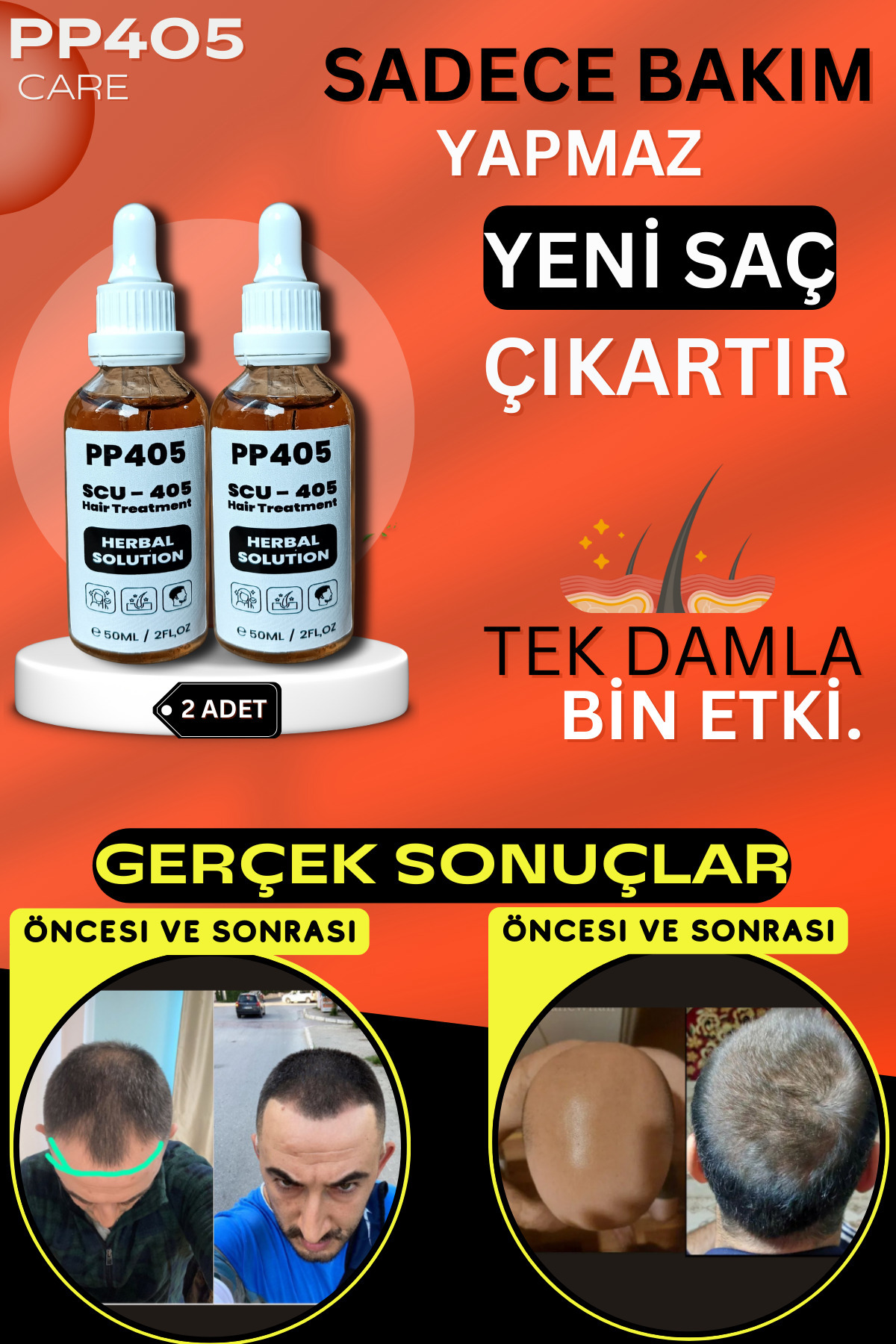 Saç Çıkartıcı ve Gürleştirici Serum Kellik Karşıtı Kel Bölgeler İçin Hızlı Saç Uzatma - 2 Adet — 45256525352