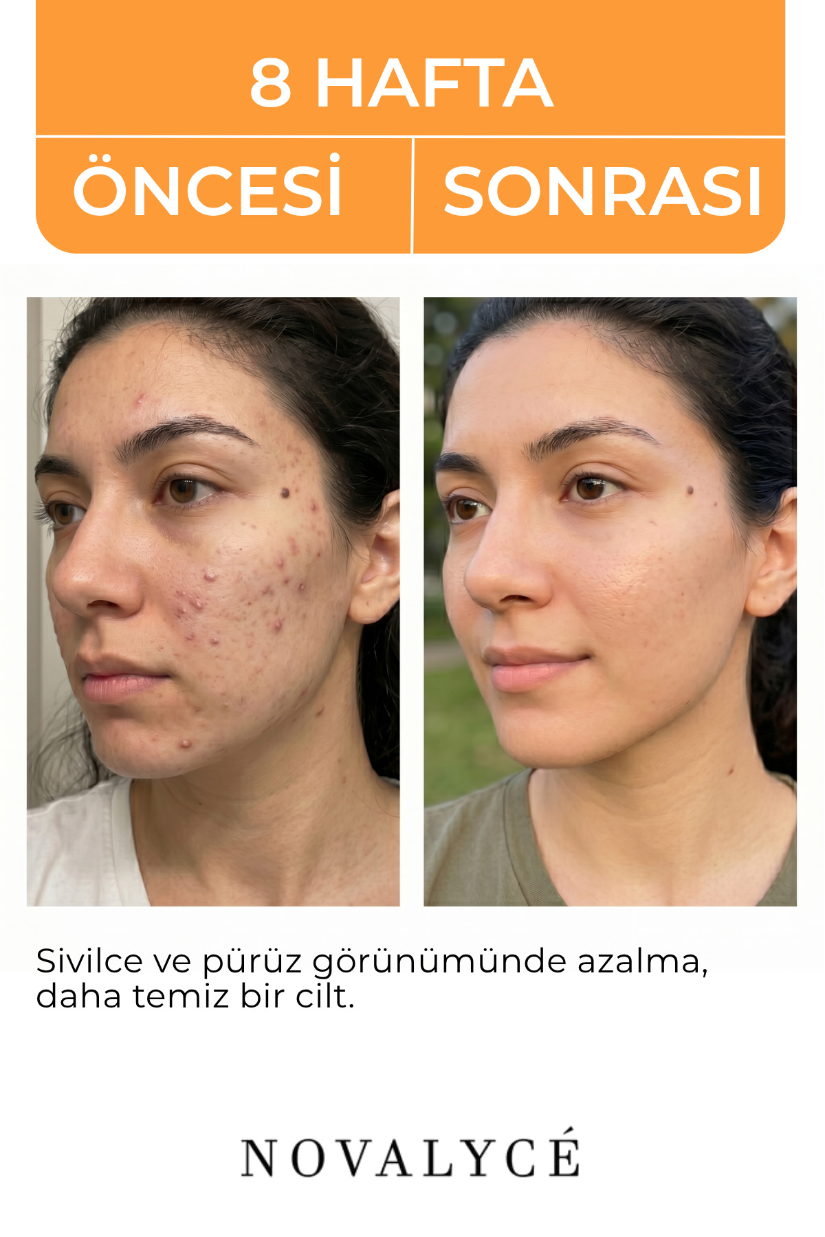 Glikolik Asit Tonik Cilt Yenileyici ve Gözenek Sıkılaştırıcı Tüm Ciltler Için — NovalyceGlycolicAcidToner — تصویر 4 از 7