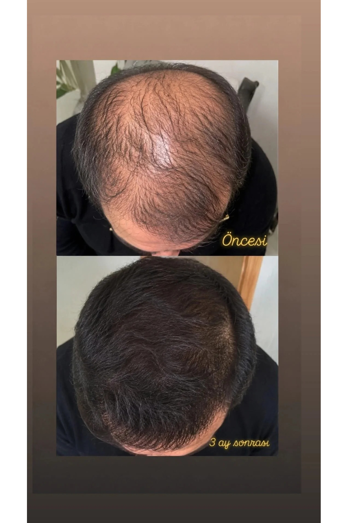 X-GrowthPecia HAİRPECİA Saç Çıkarıcı ve Gürleştirici Serum - 50 mL (PRP etkili büyüme faktörleri ve Mezoterapi etkili vitamin Komplexi.) — X-GrowthPecia 50ml