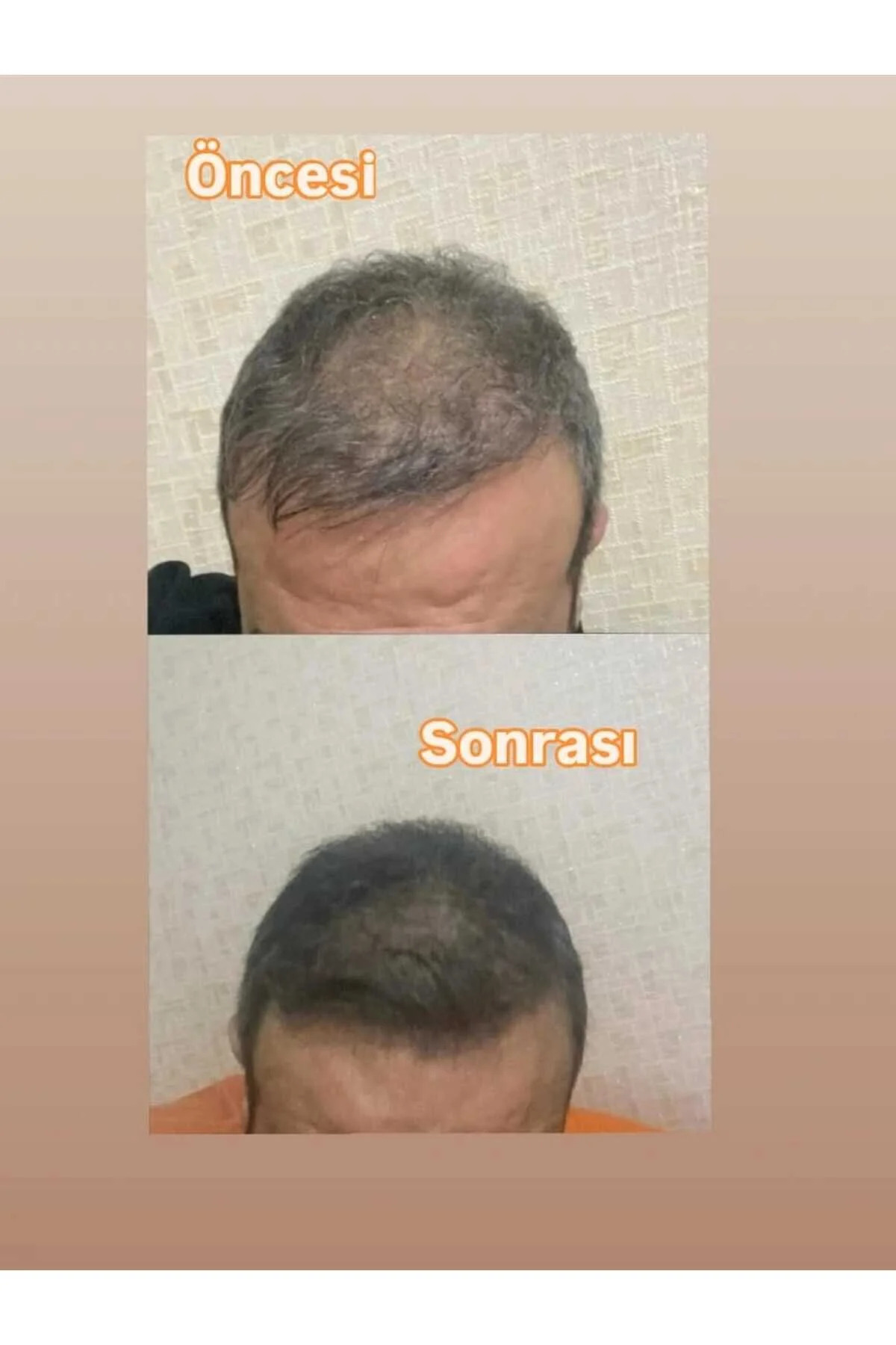 HAİRPECİA Saç Çıkarıcı ve Gürleştirici Serum - 50 mL (PRP etkili büyüme faktörleri ve Mezoterapi etkili vitamin Komplexi.) — X-GrowthPecia 50ml — تصویر 7 از 9
