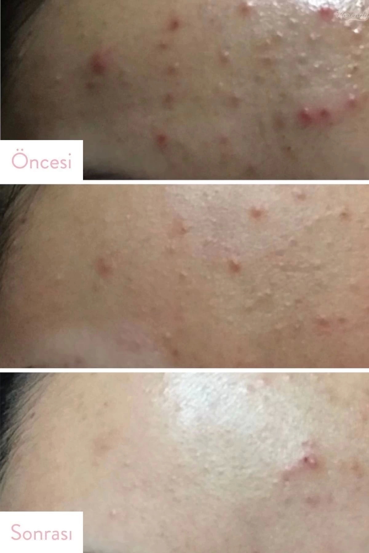 Aha Bha Pha 30 Days Miracle Serum (KORENDY) Yatıştırıcı Aydınlatıcı Serum 50 ml — SBM-ABP-03-M-N — تصویر 4 از 6