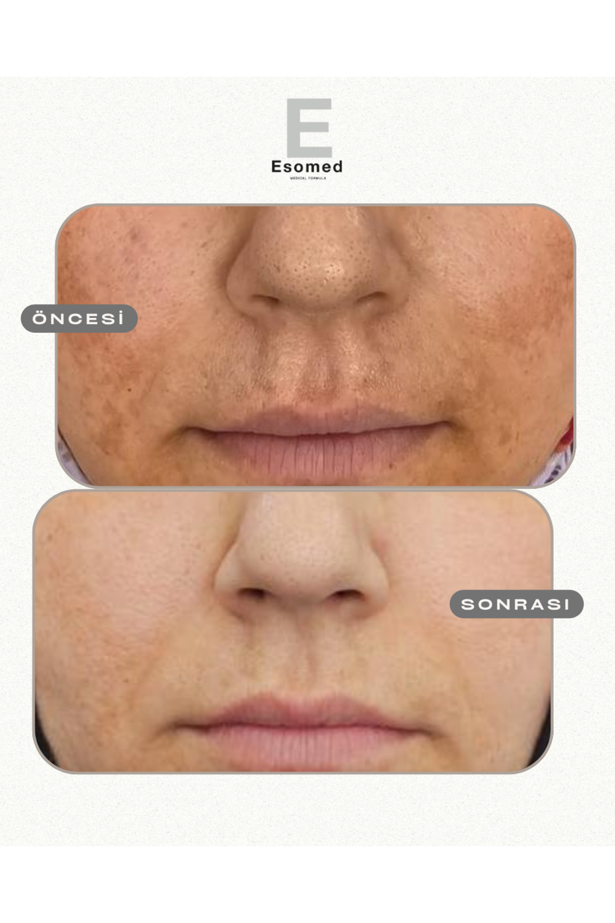 Daha Hassas Ciltler İçin Güneş Kremi SPF50+ Yüksek Koruma Göz Yakmayan Terletmeyen Leke Karşıtı Aydınlatıcı Etkili — pigment-soft — تصویر 3 از 9