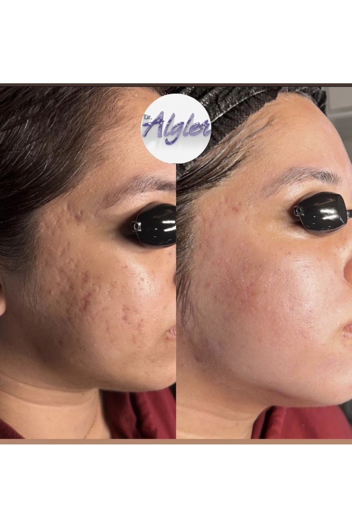 اسکراب صورت لایه بردار جلبک دریایی مراقبت از پوست ماسک جلبک دریایی لایه بردار پوست لک آکنه جوش ۵ کاربرد — ۵ عدد — تصویر 6 از 7