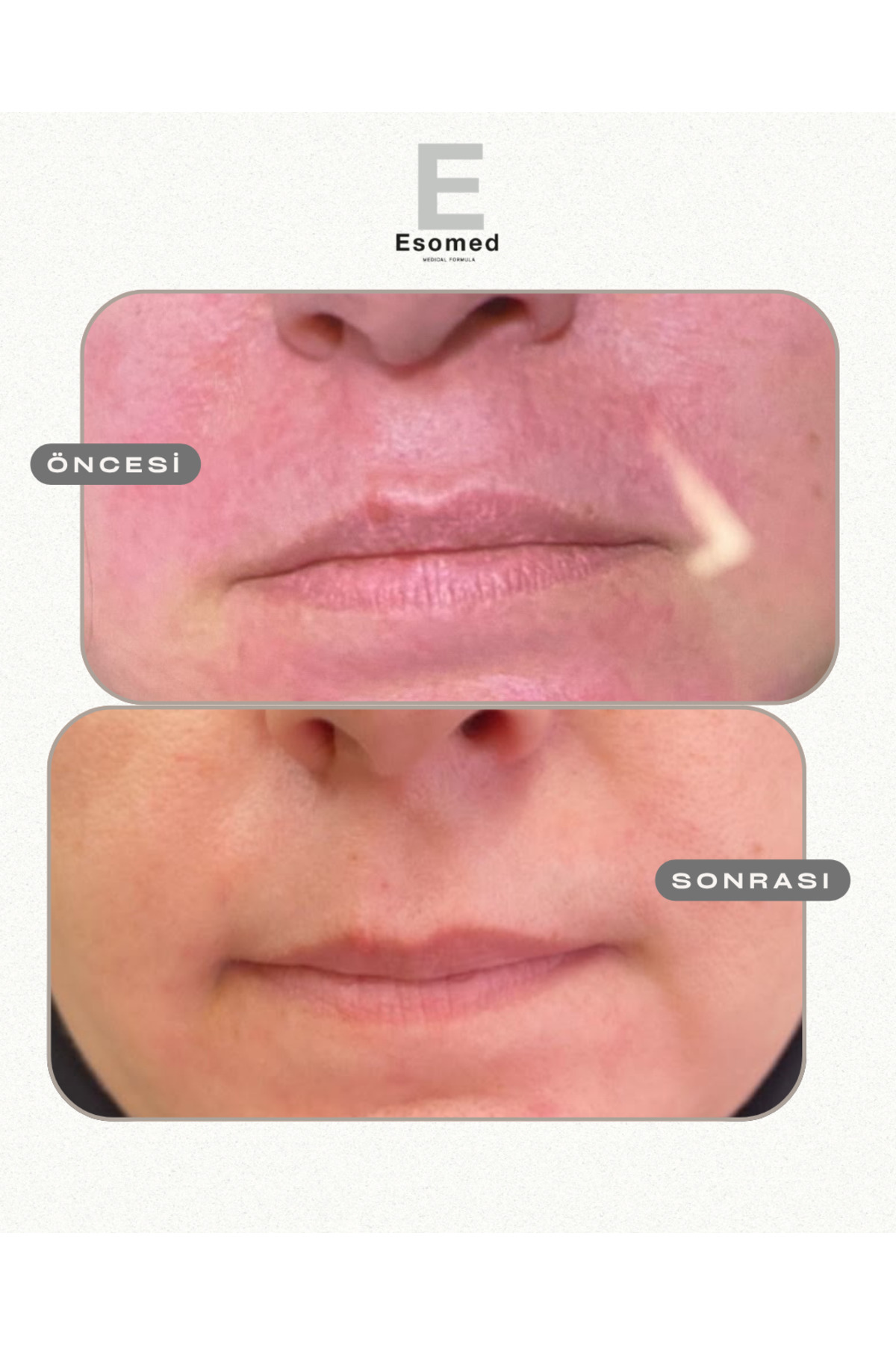 Esomed RS Rosasens Güneş Kremi SPF 50+ Güneş Koruyucu Krem Hassas Ciltler İçin Yoğun Koruma & Nem Desteği
